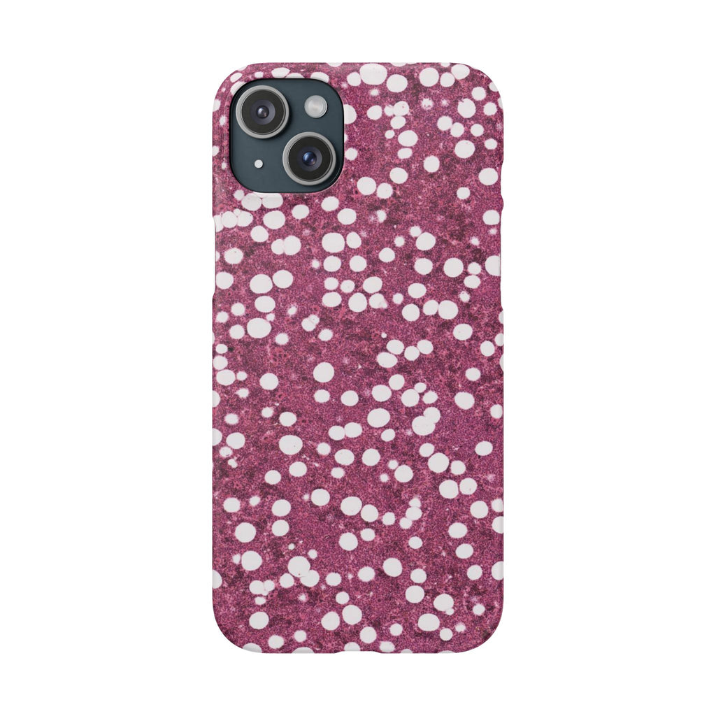 Slim Case Myelolipom