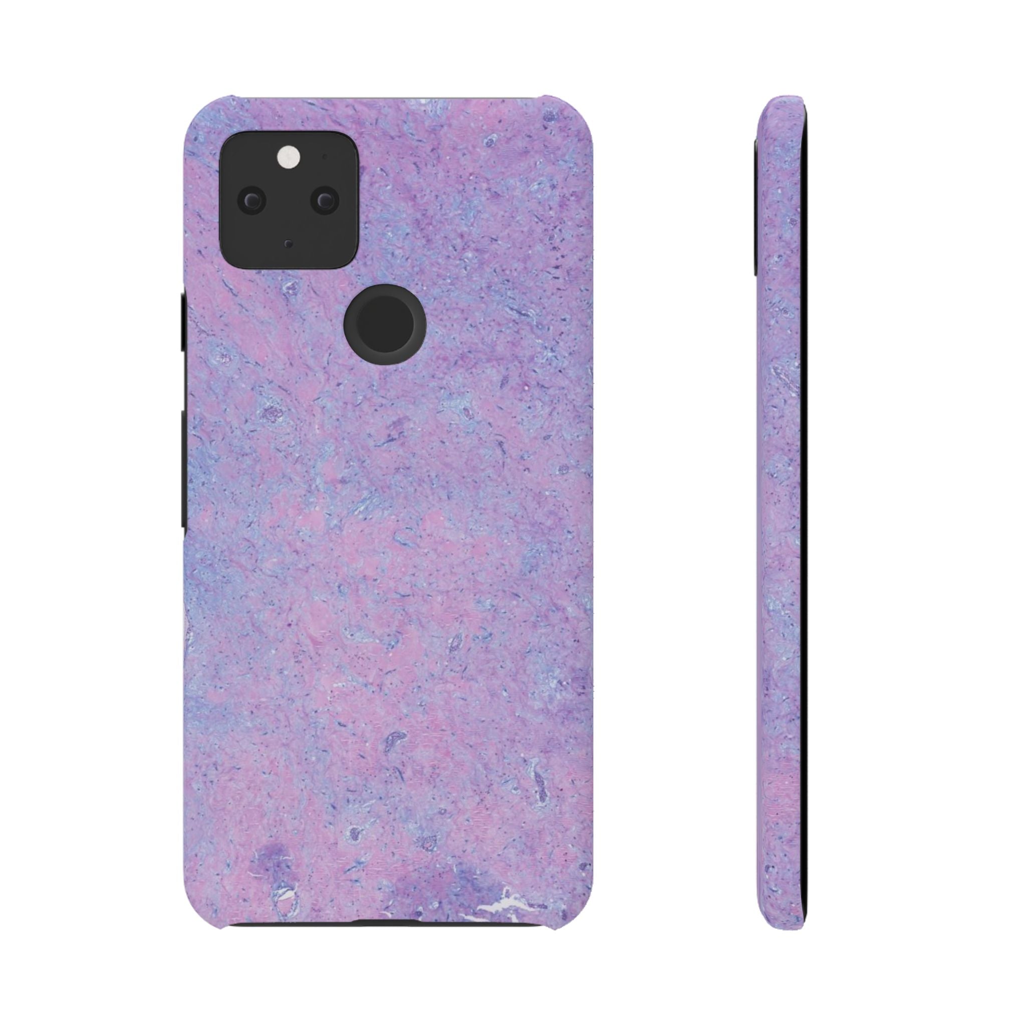 Slim Case Arterielles Myxom
