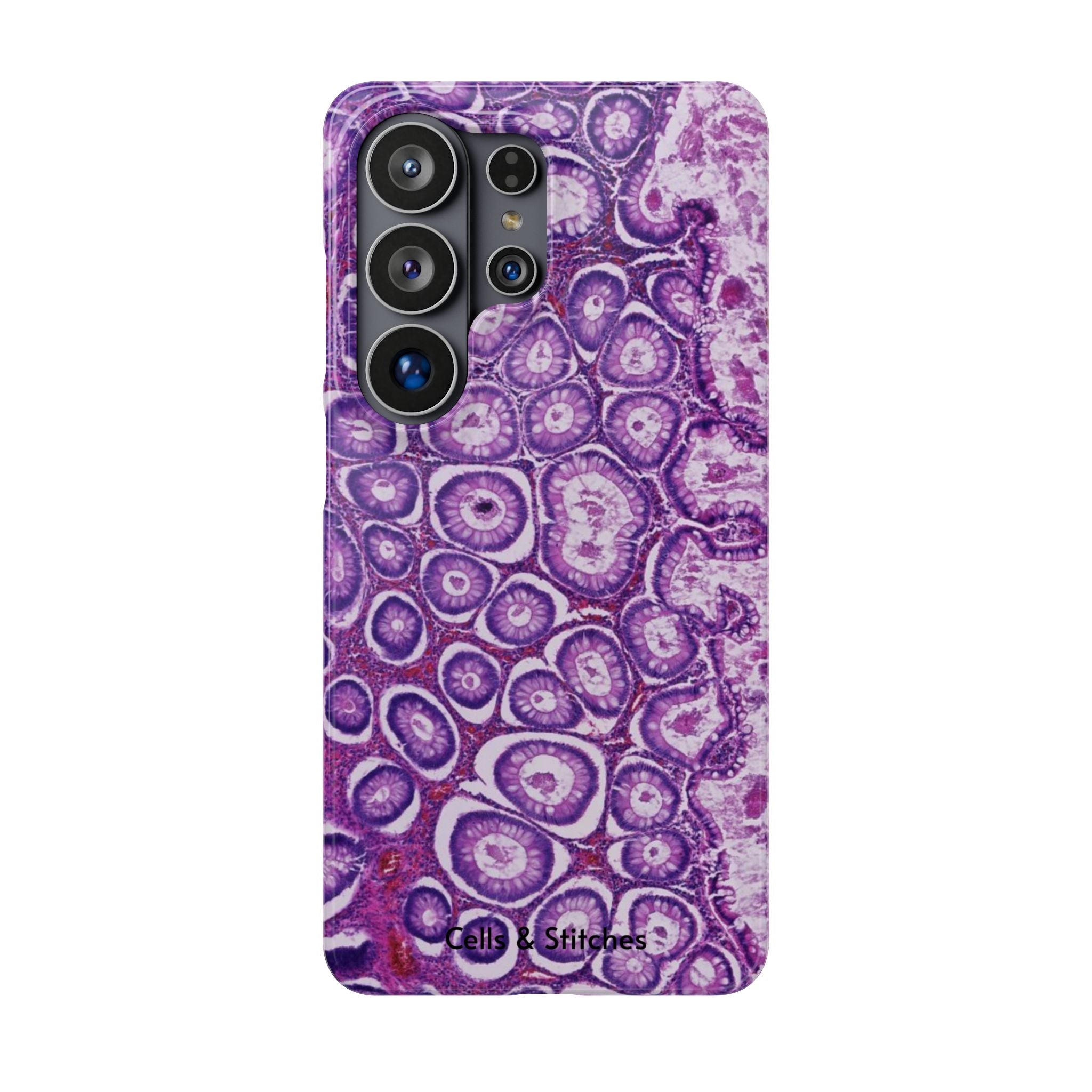 Slim Case Peutz-Jeghers Polyp