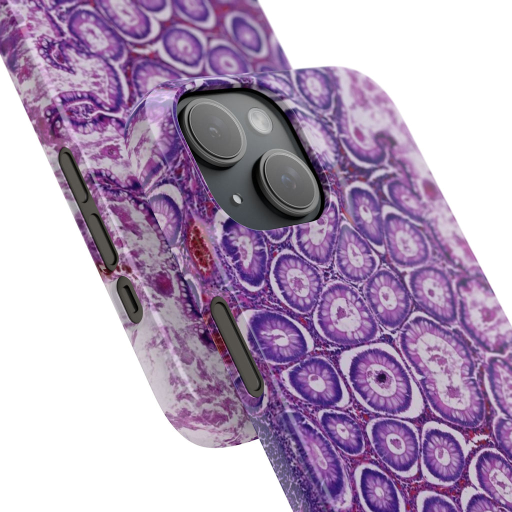 Slim Case Peutz-Jeghers Polyp