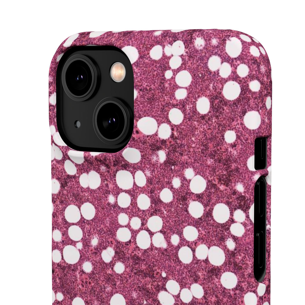Slim Case Myelolipom