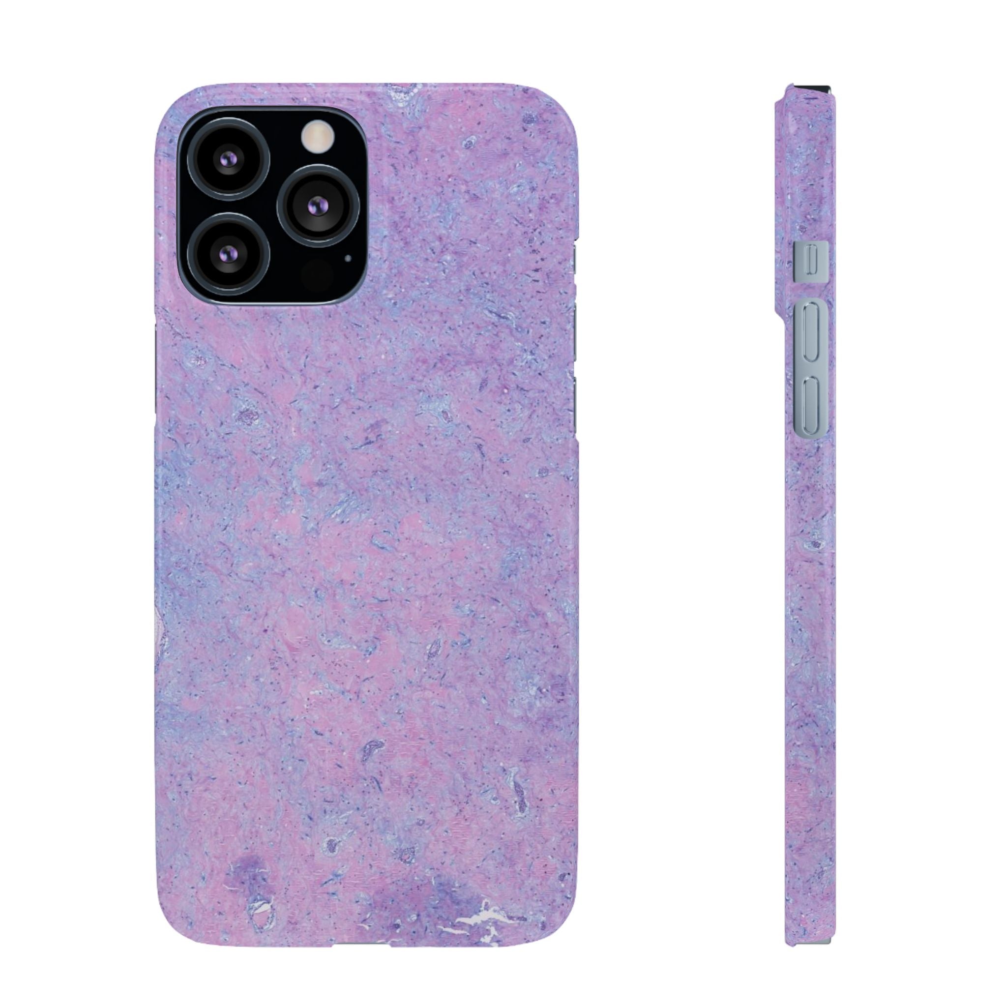 Slim Case Arterielles Myxom