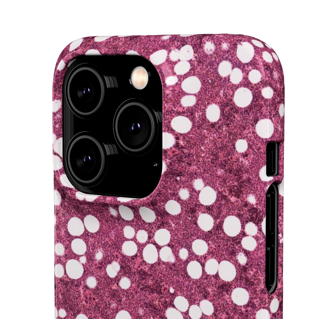 Slim Case Myelolipom