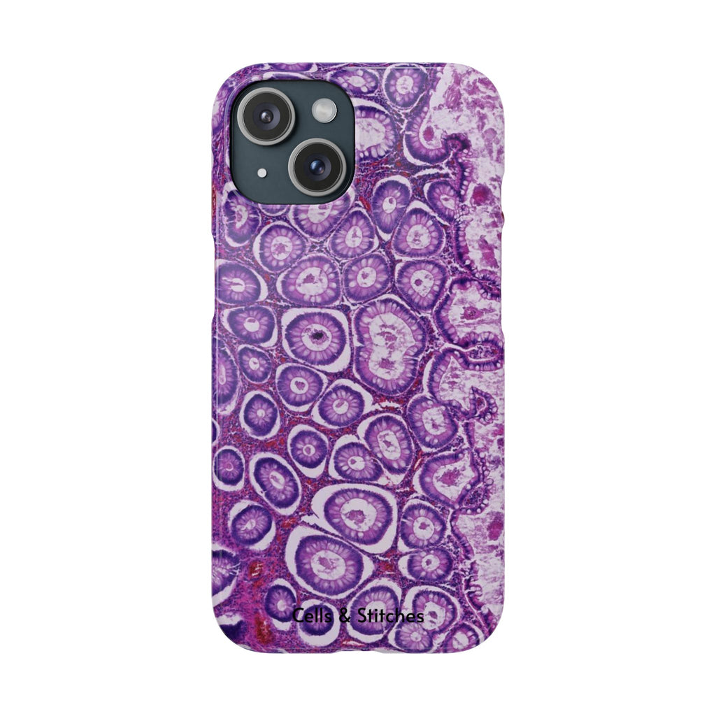 Slim Case Peutz-Jeghers Polyp