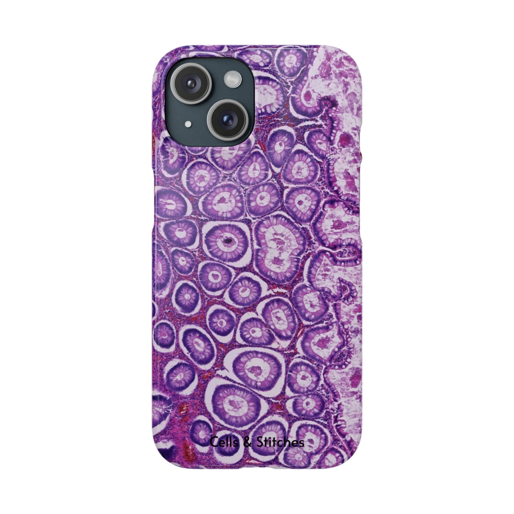 Slim Case Peutz-Jeghers Polyp