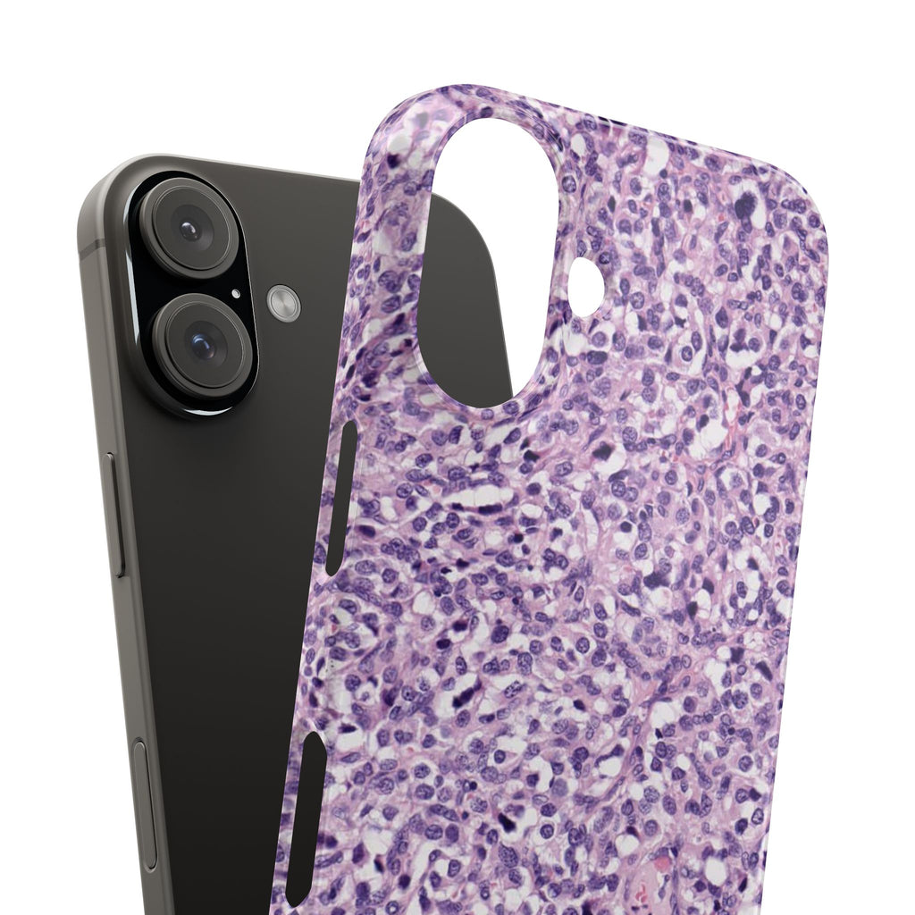 Slim Case Paraganglion