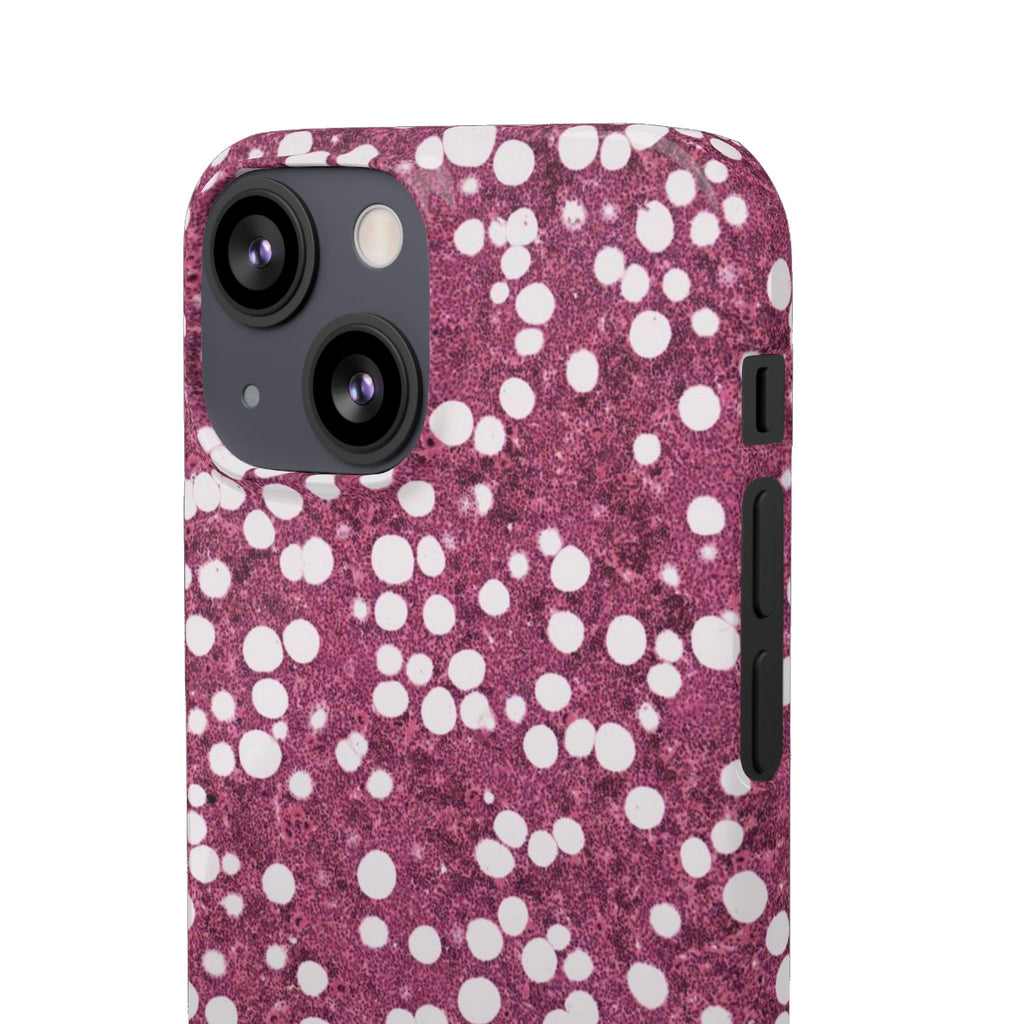 Slim Case Myelolipom