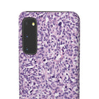Slim Case Paraganglion
