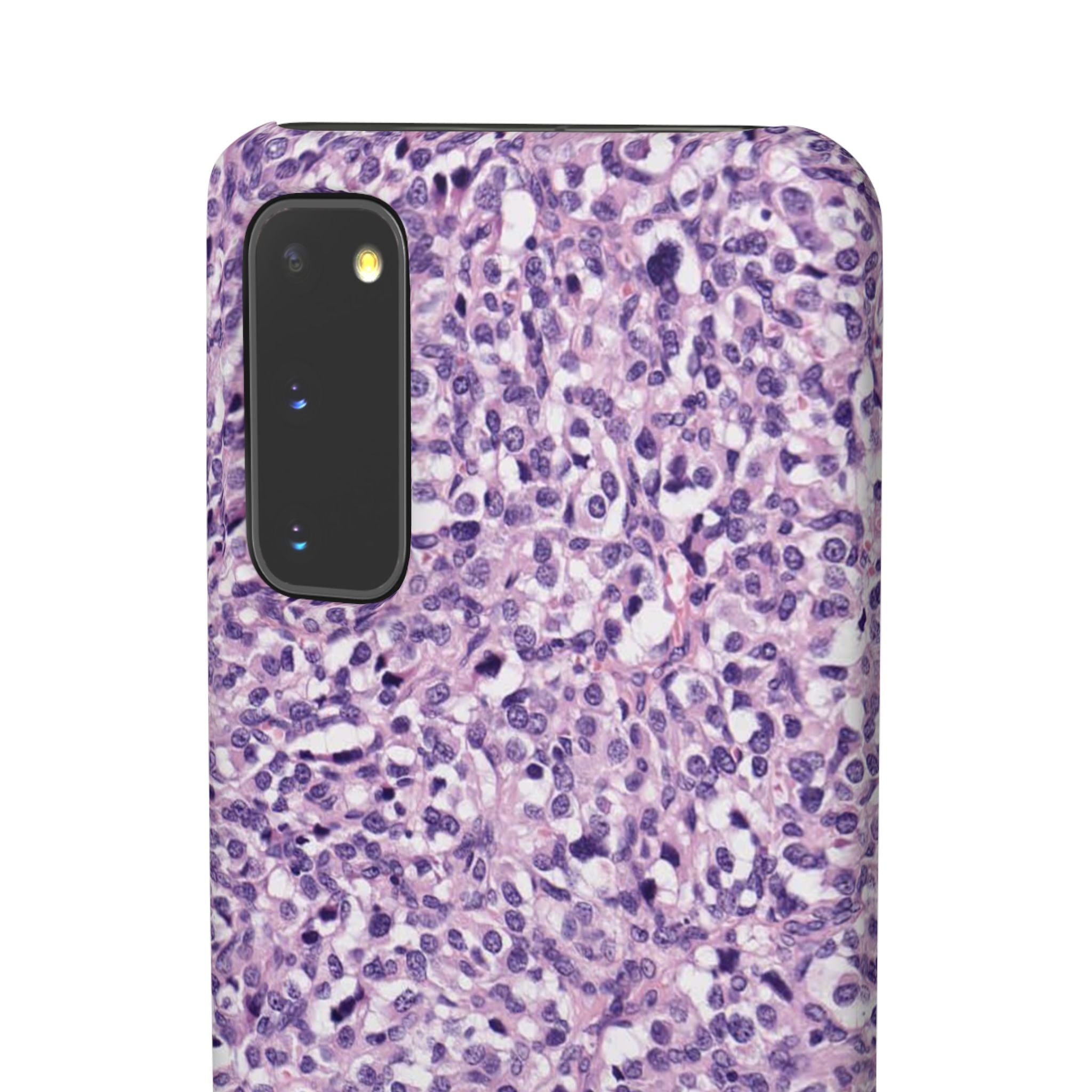 Slim Case Paraganglion