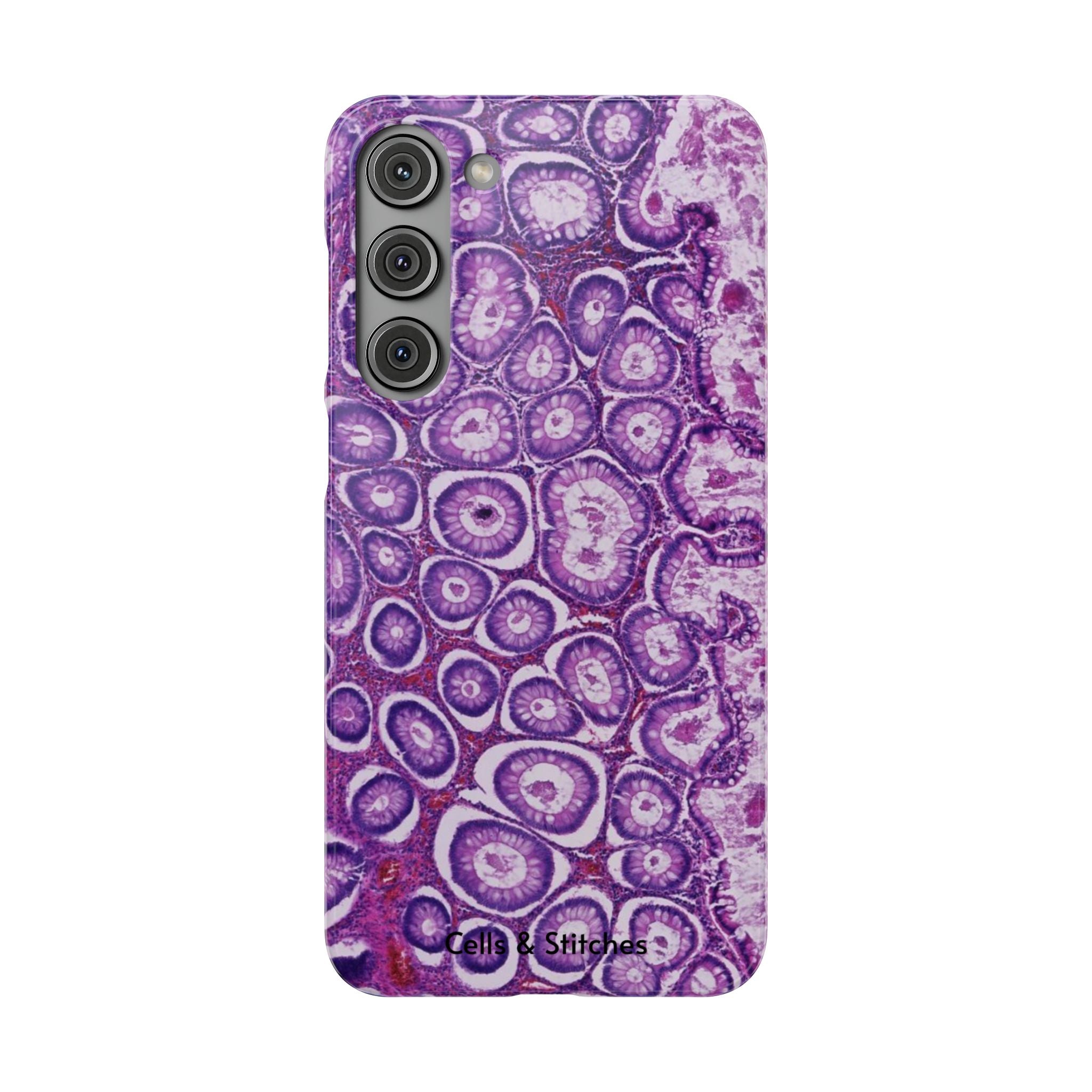 Slim Case Peutz-Jeghers Polyp