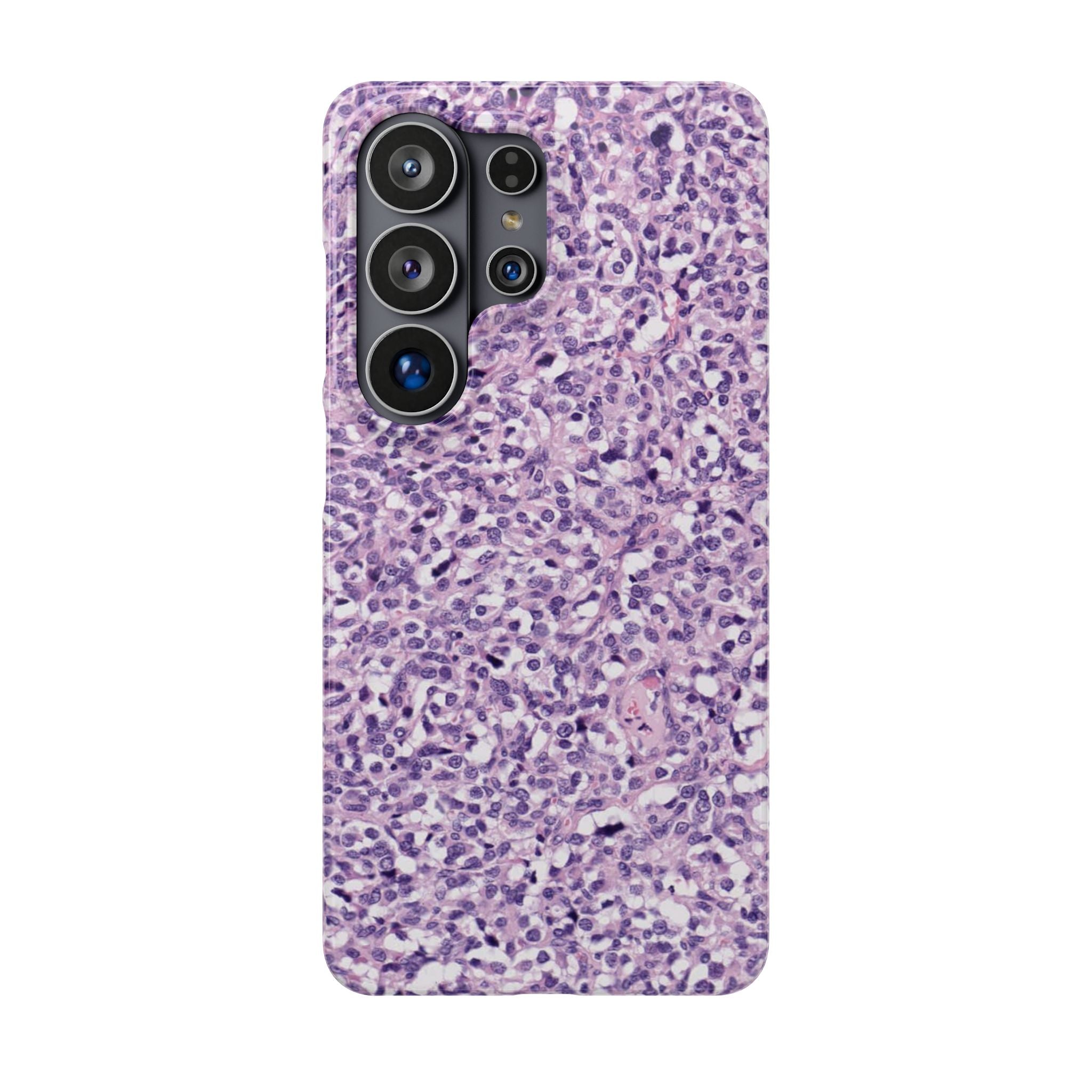 Slim Case Paraganglion
