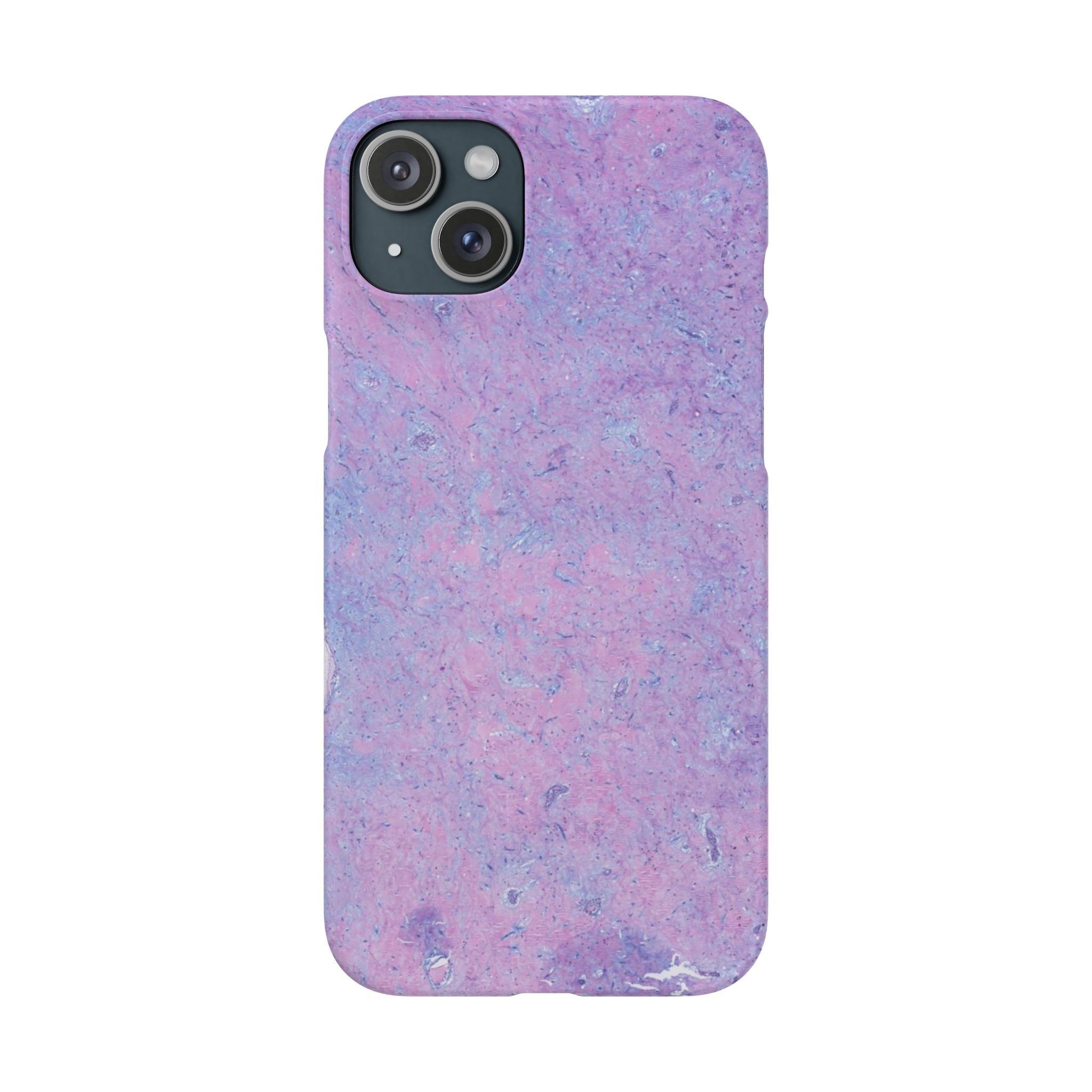 Slim Case Arterielles Myxom