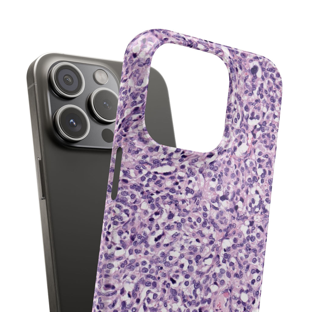 Slim Case Paraganglion