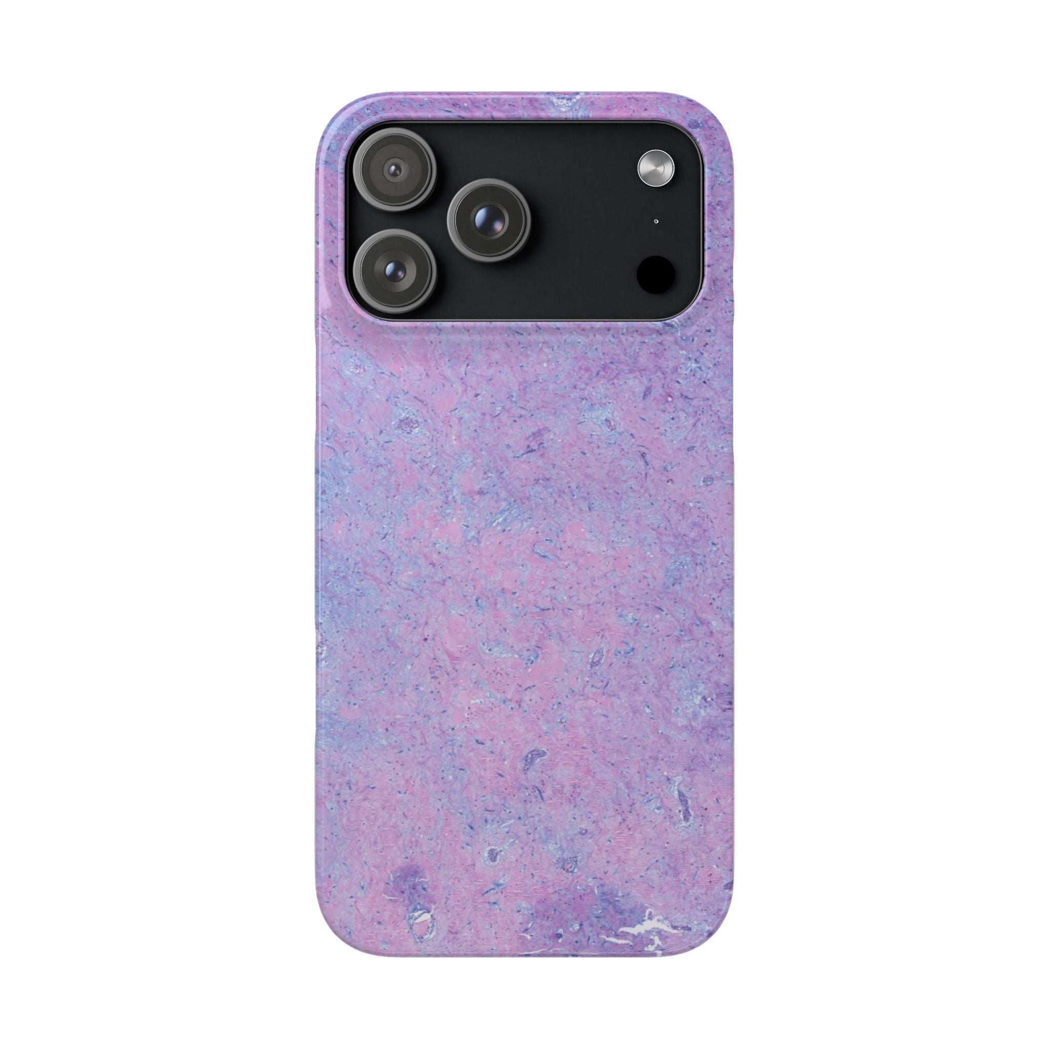 Slim Case Arterielles Myxom