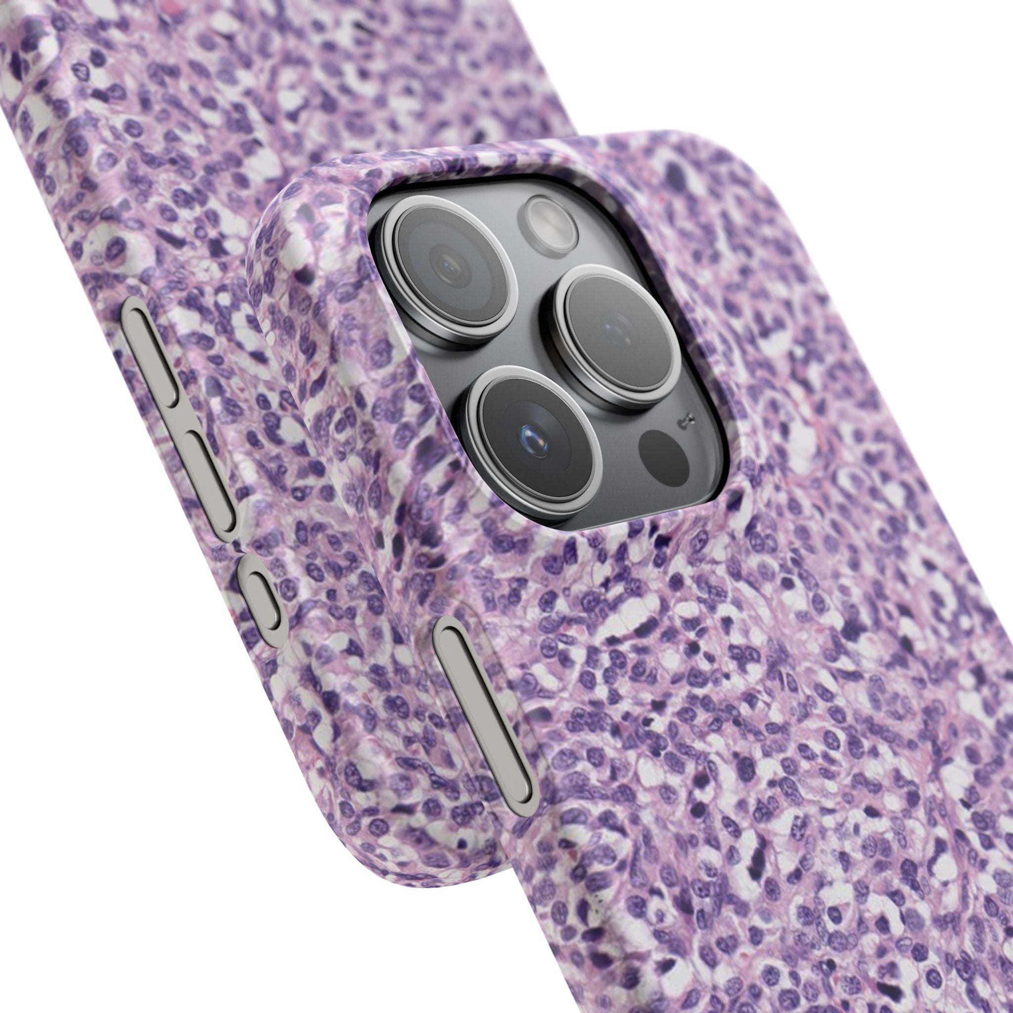 Slim Case Paraganglion