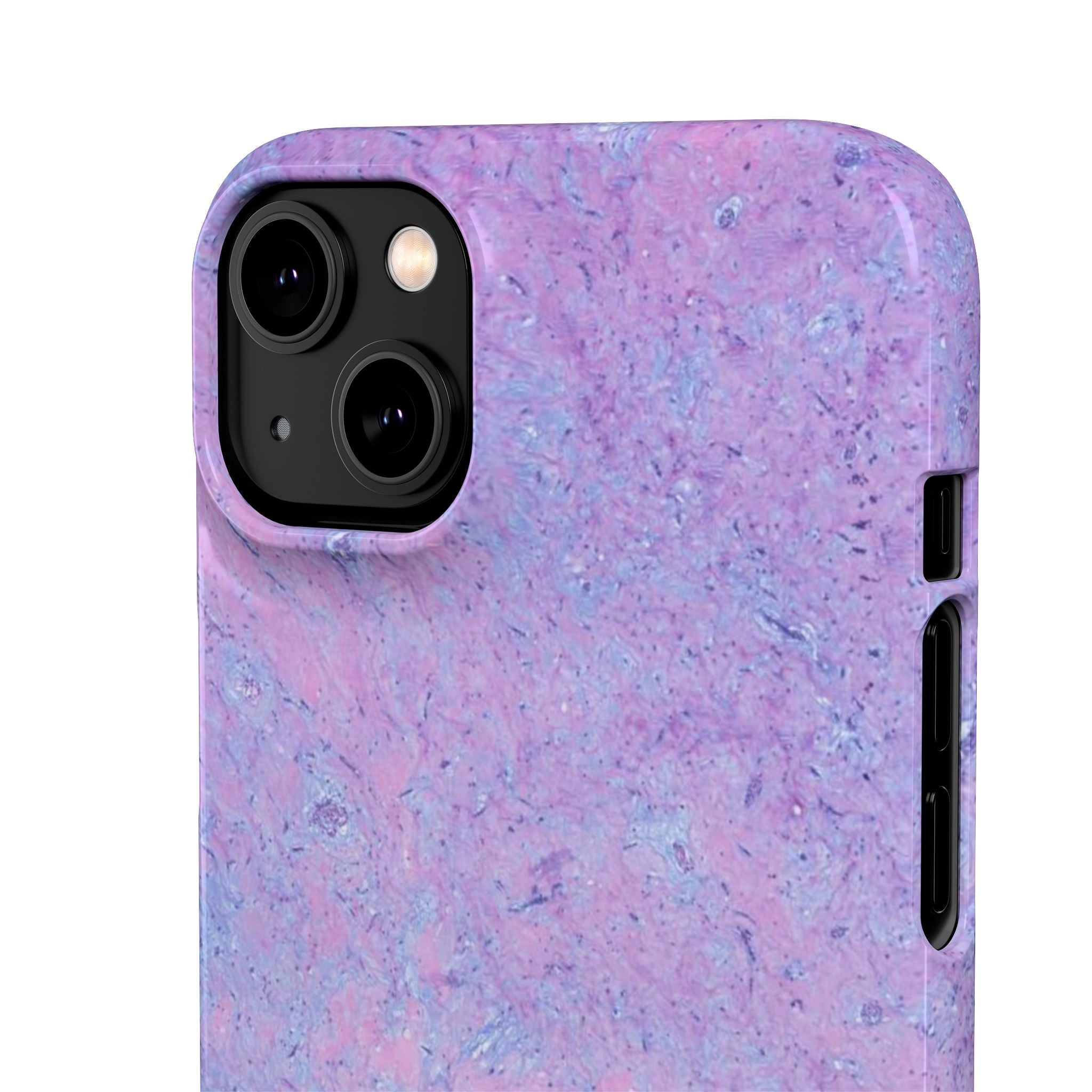 Slim Case Arterielles Myxom