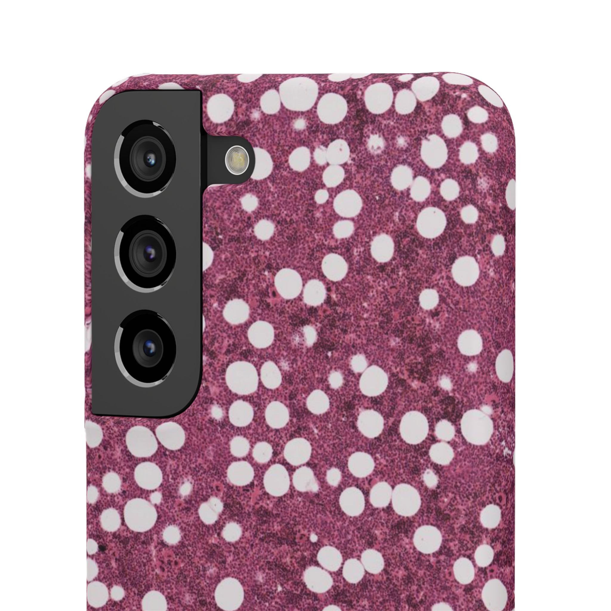 Slim Case Myelolipom