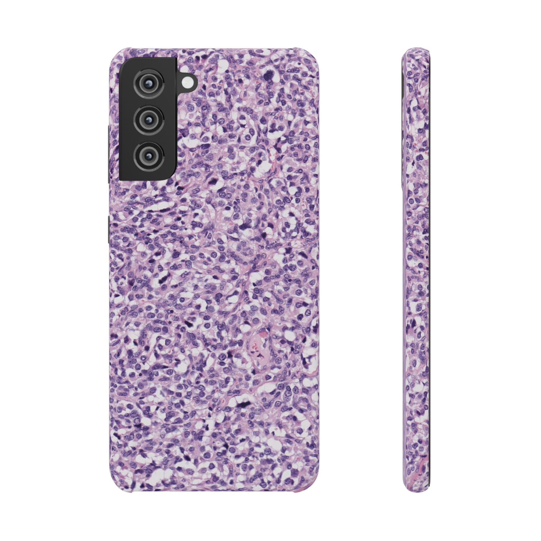 Slim Case Paraganglion