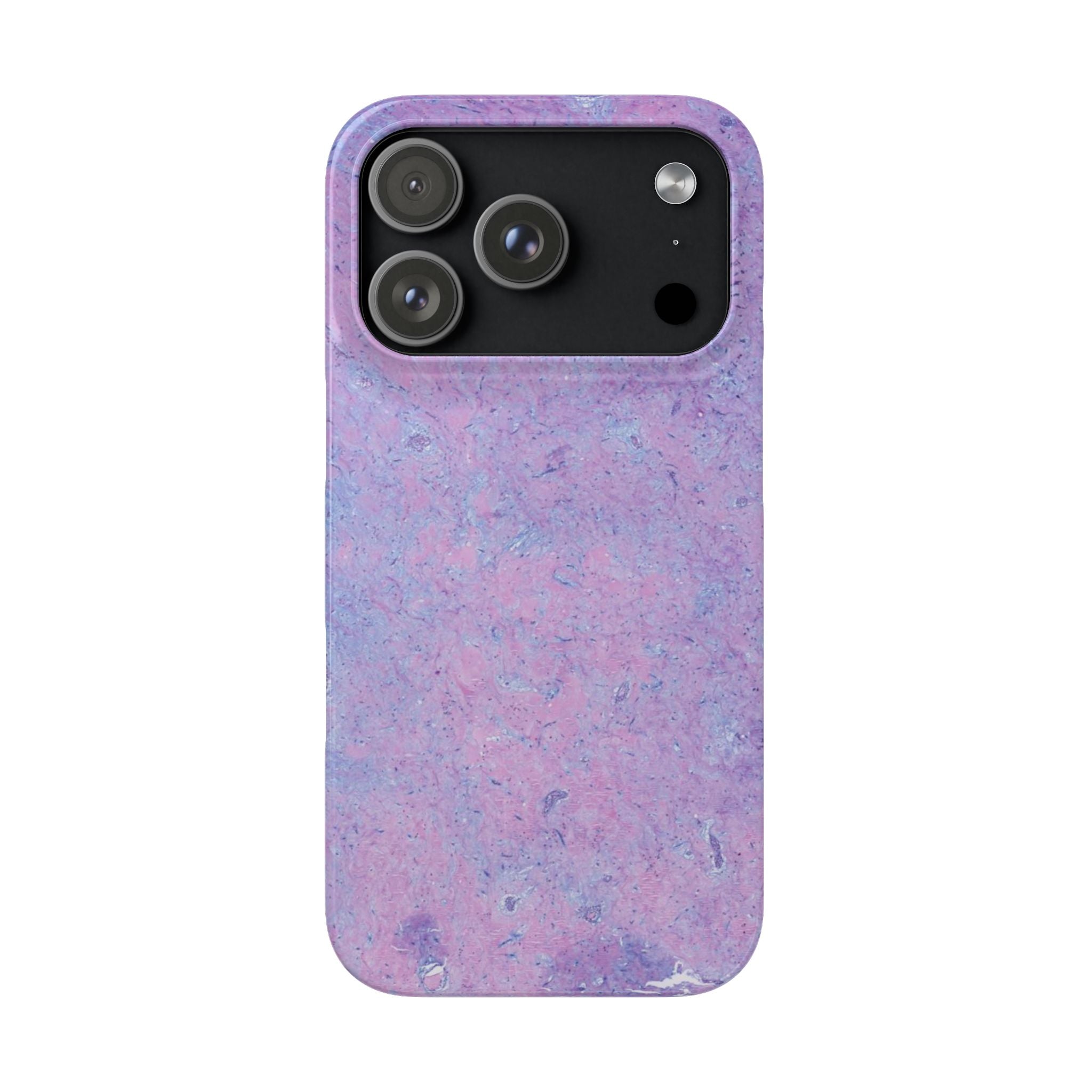 Slim Case Arterielles Myxom