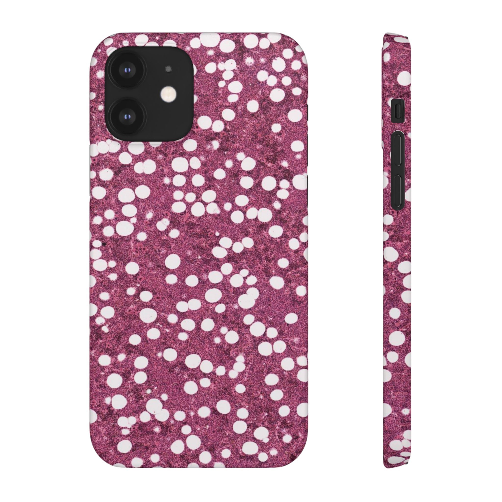 Slim Case Myelolipom