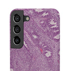Slim Case Endometrium