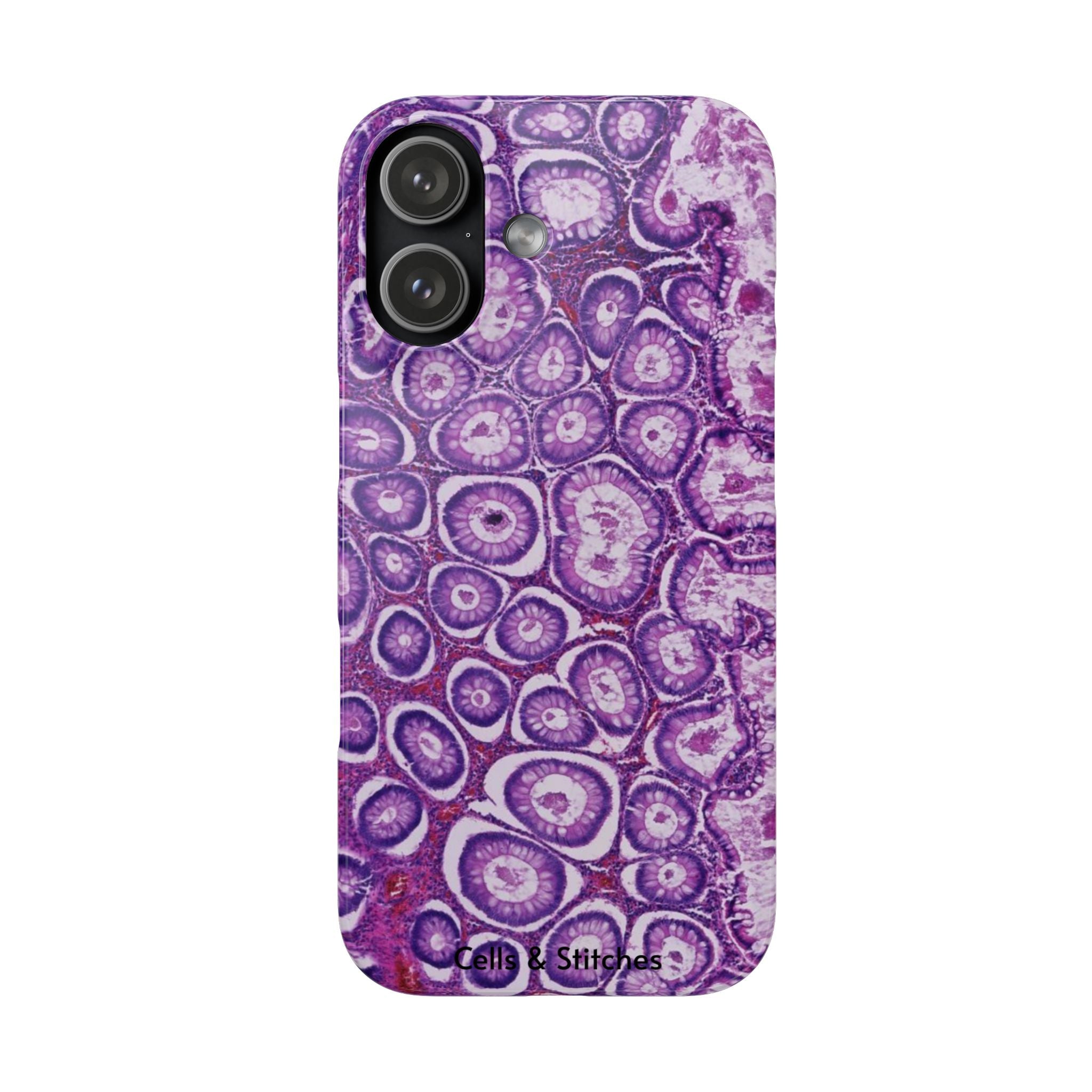 Slim Case Peutz-Jeghers Polyp