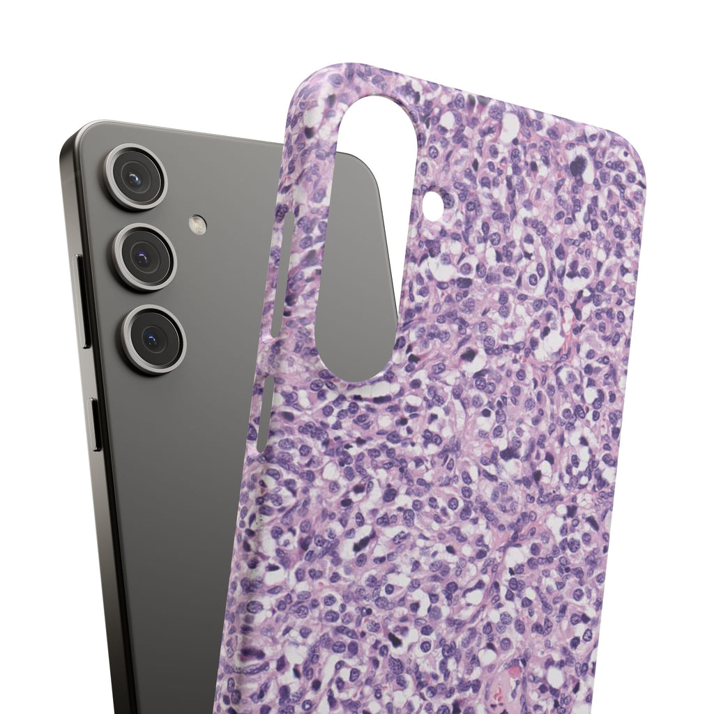 Slim Case Paraganglion