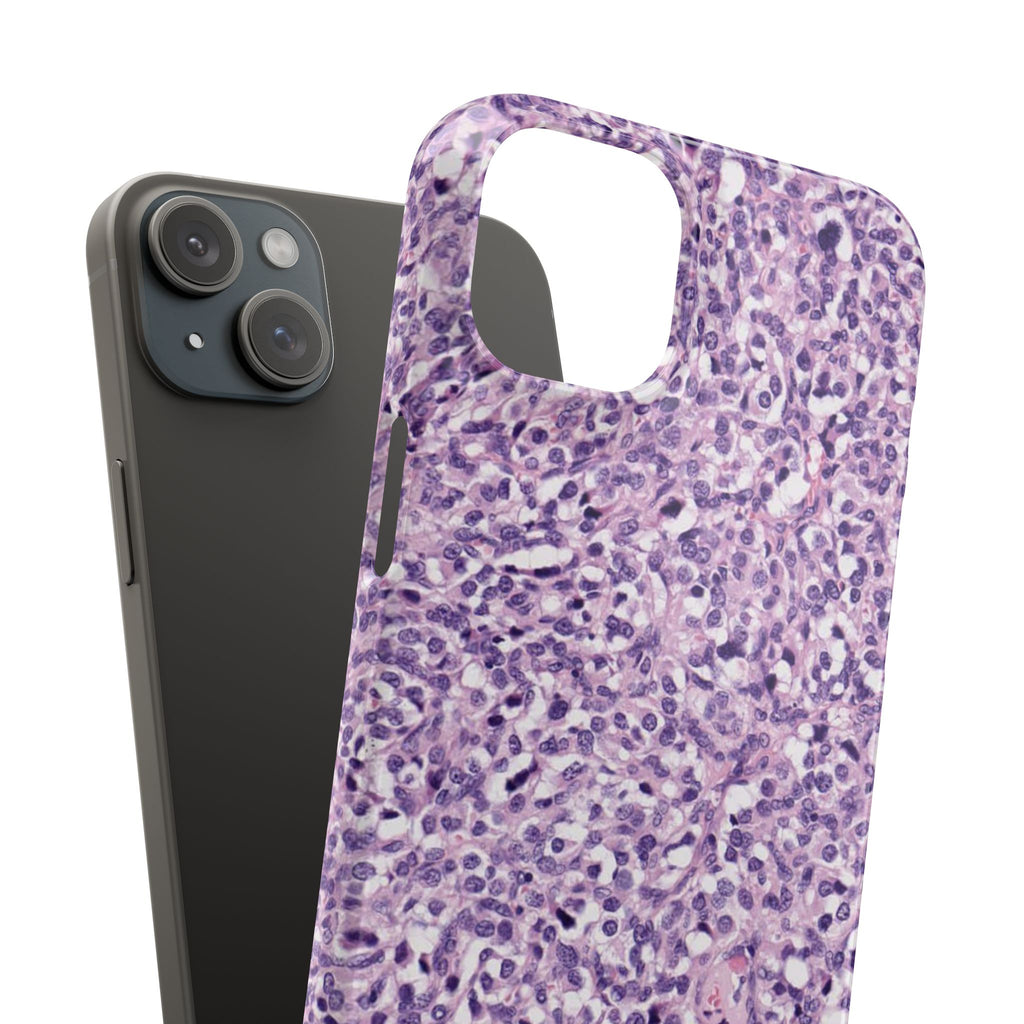 Slim Case Paraganglion
