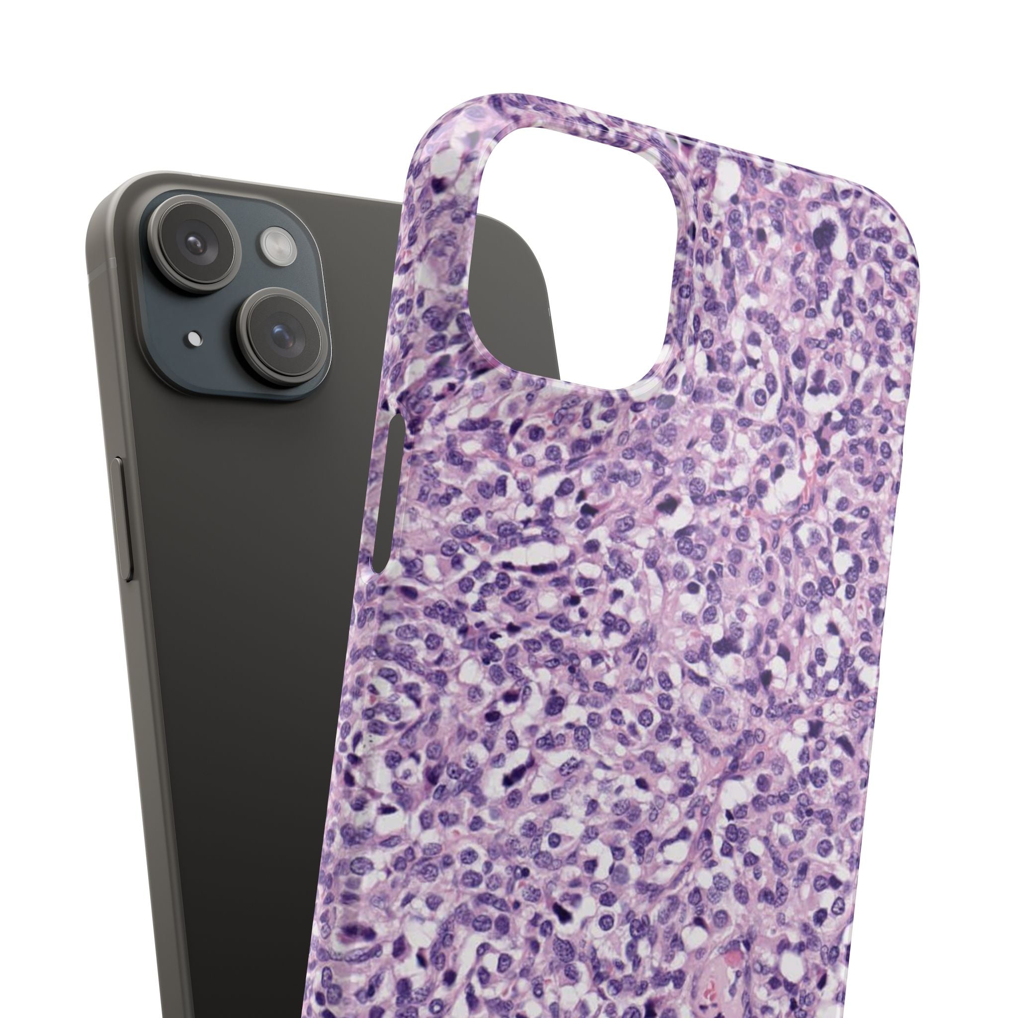 Slim Case Paraganglion