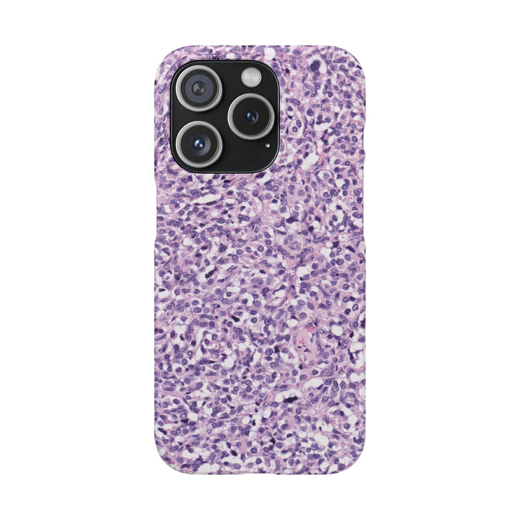 Slim Case Paraganglion