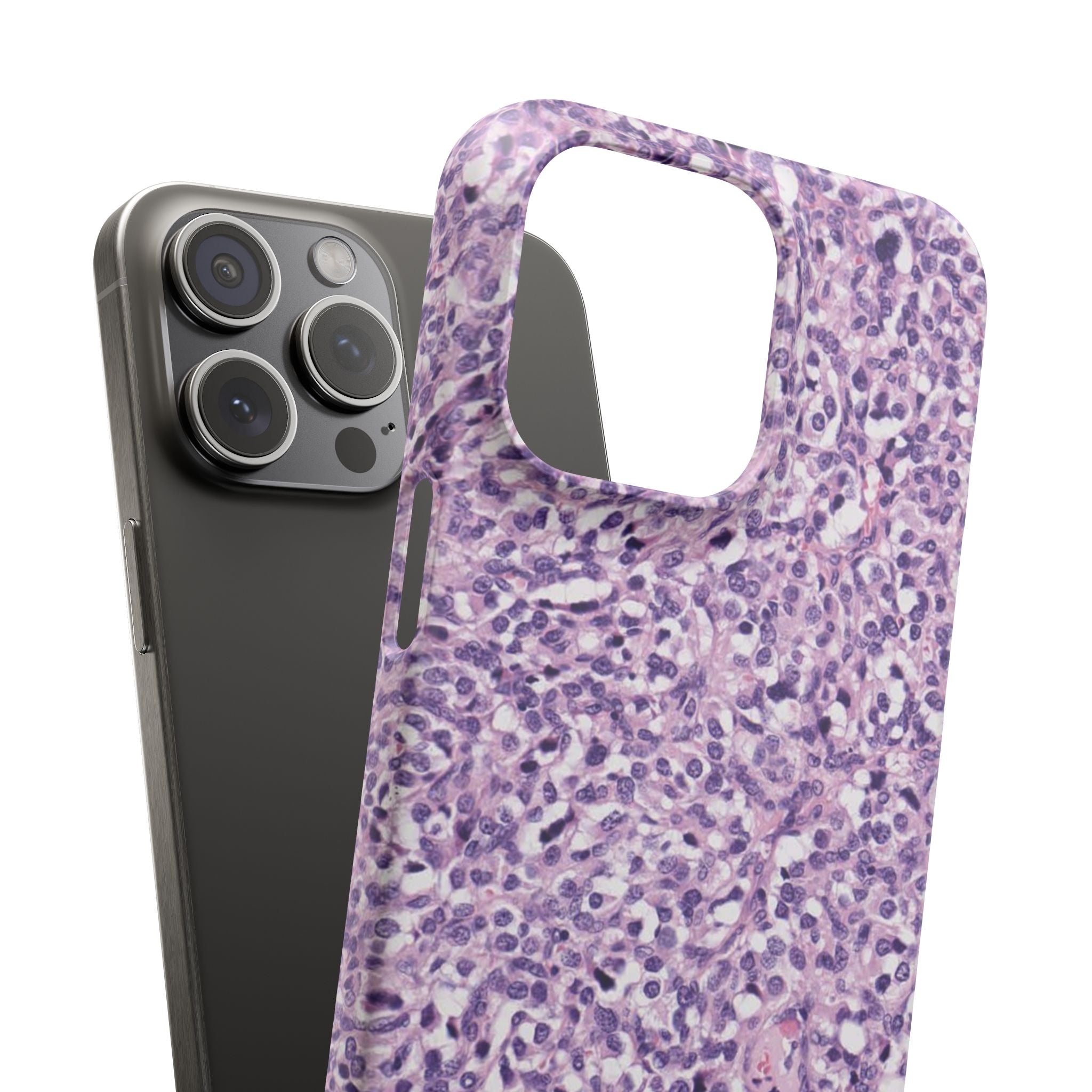 Slim Case Paraganglion