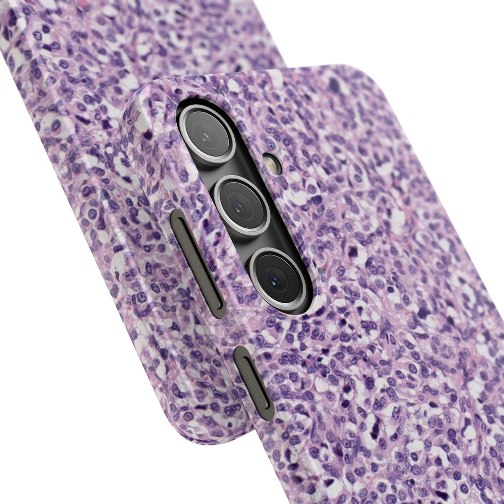 Slim Case Paraganglion