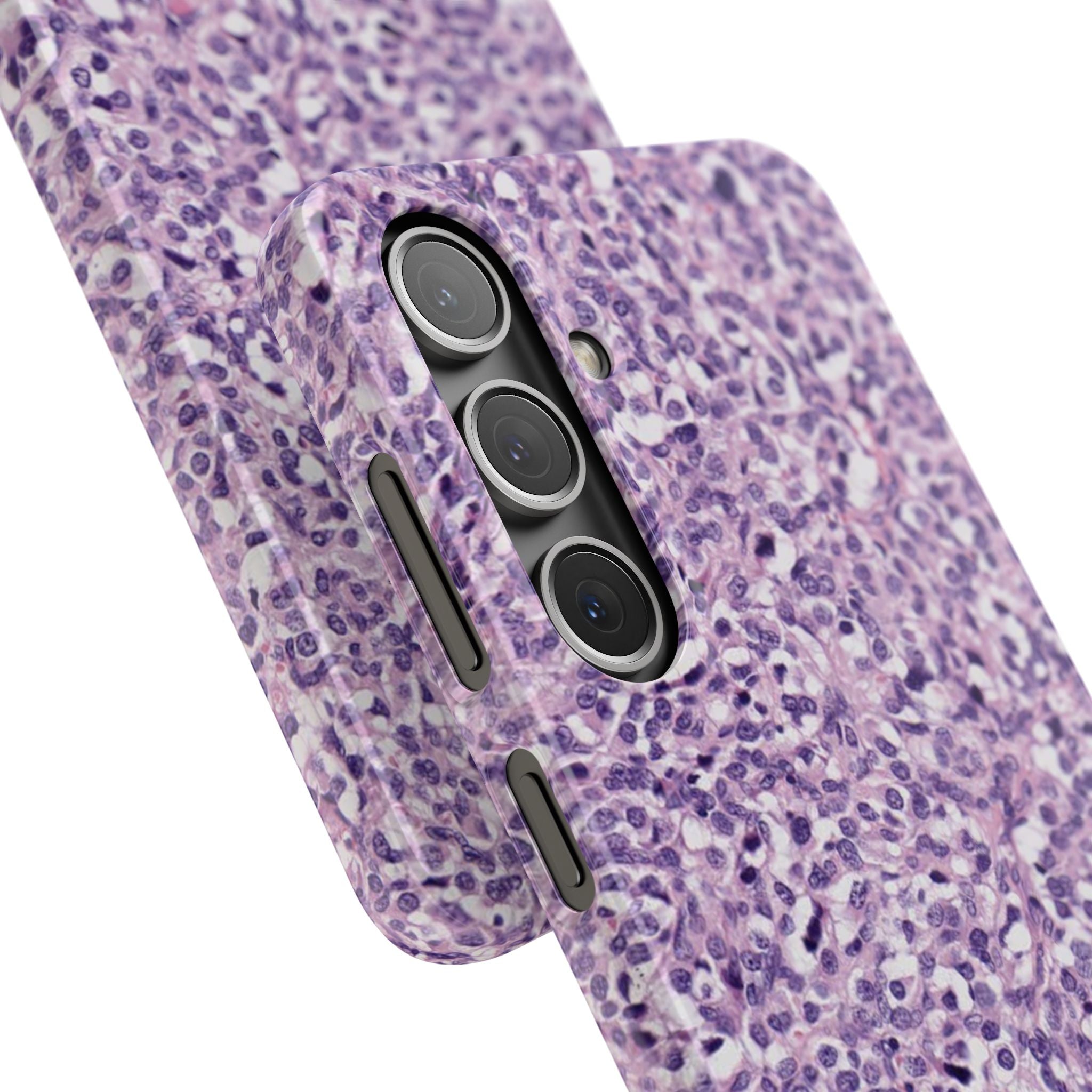 Slim Case Paraganglion