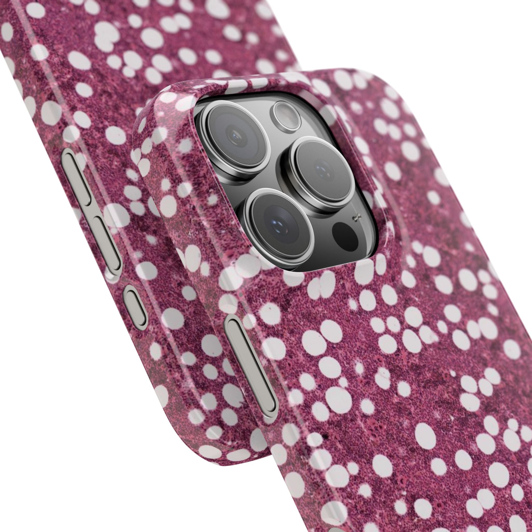 Slim Case Myelolipom
