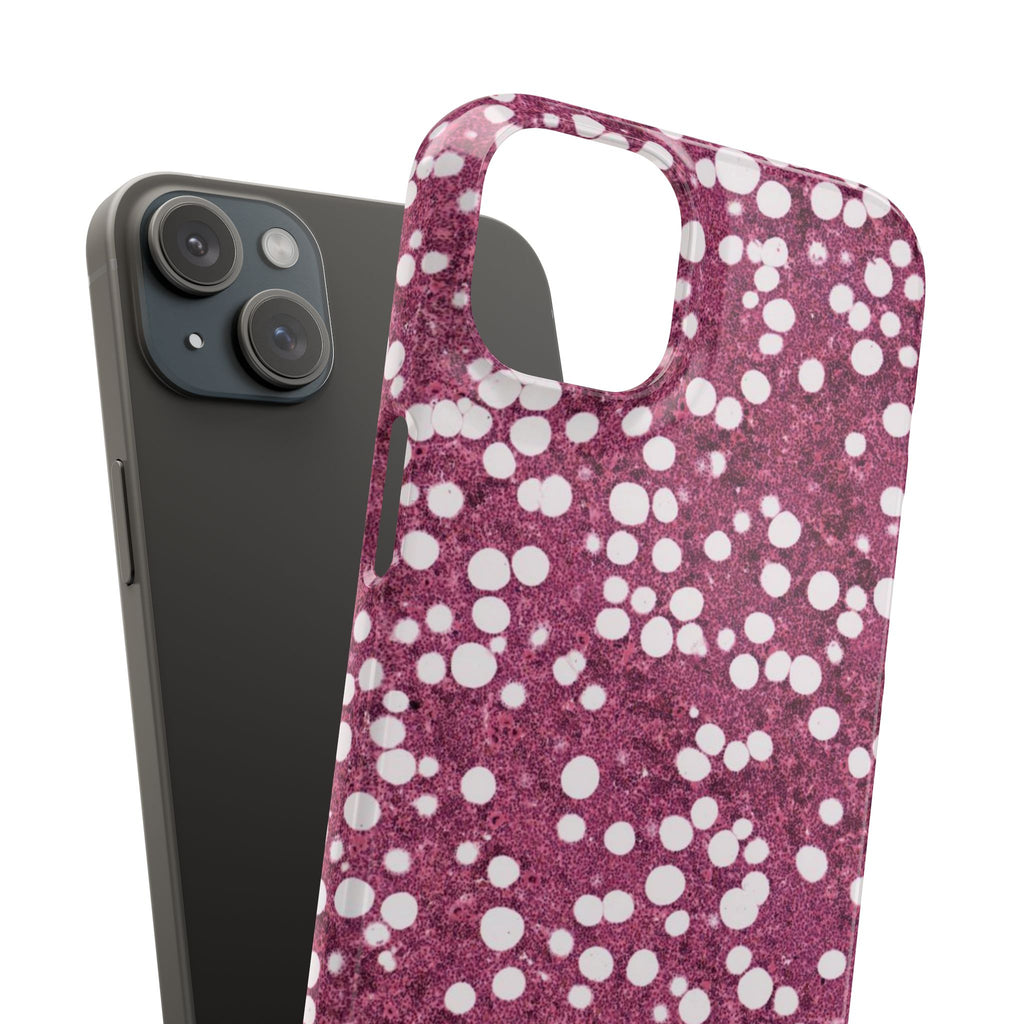 Slim Case Myelolipom