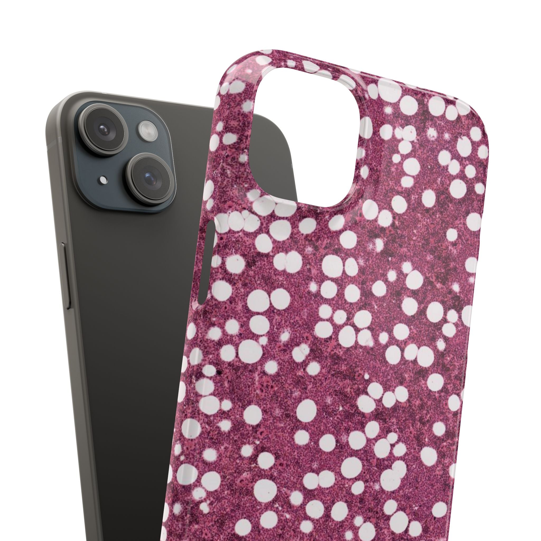 Slim Case Myelolipom