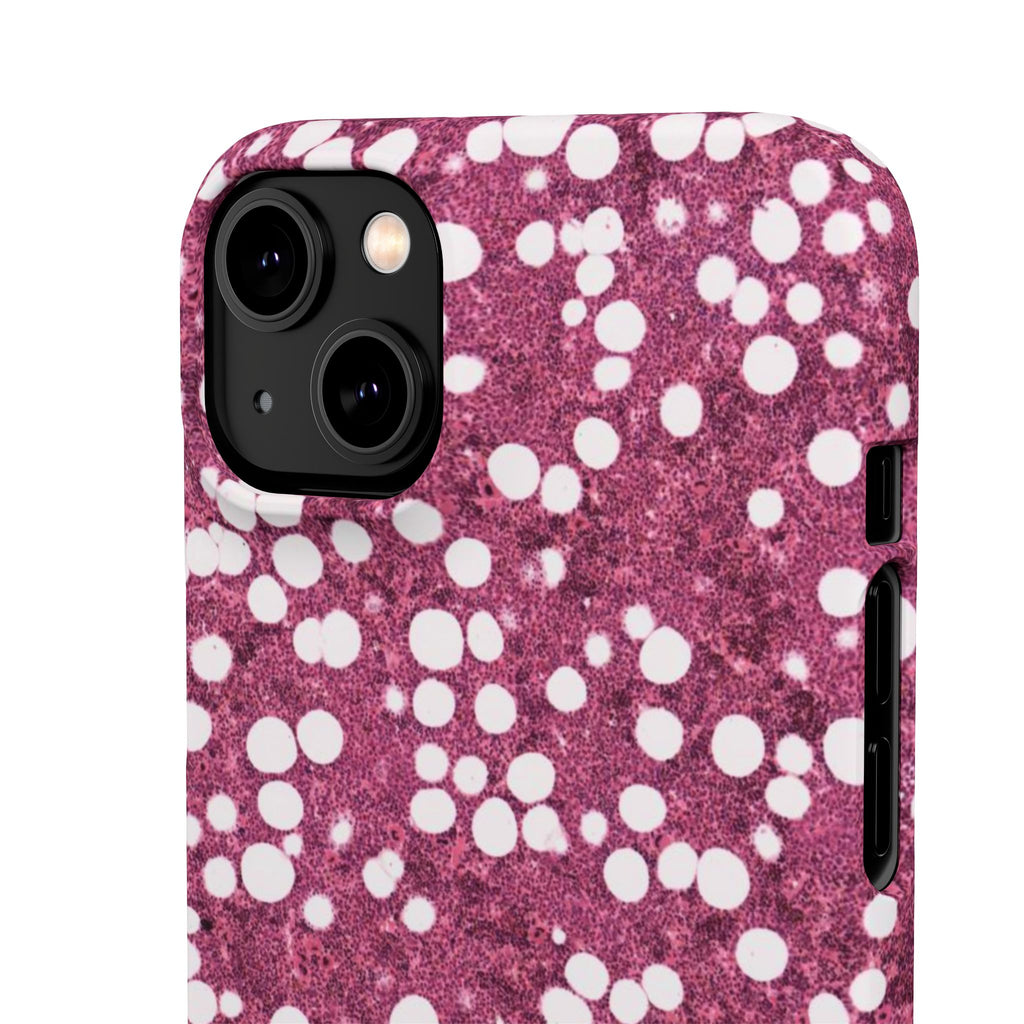 Slim Case Myelolipom