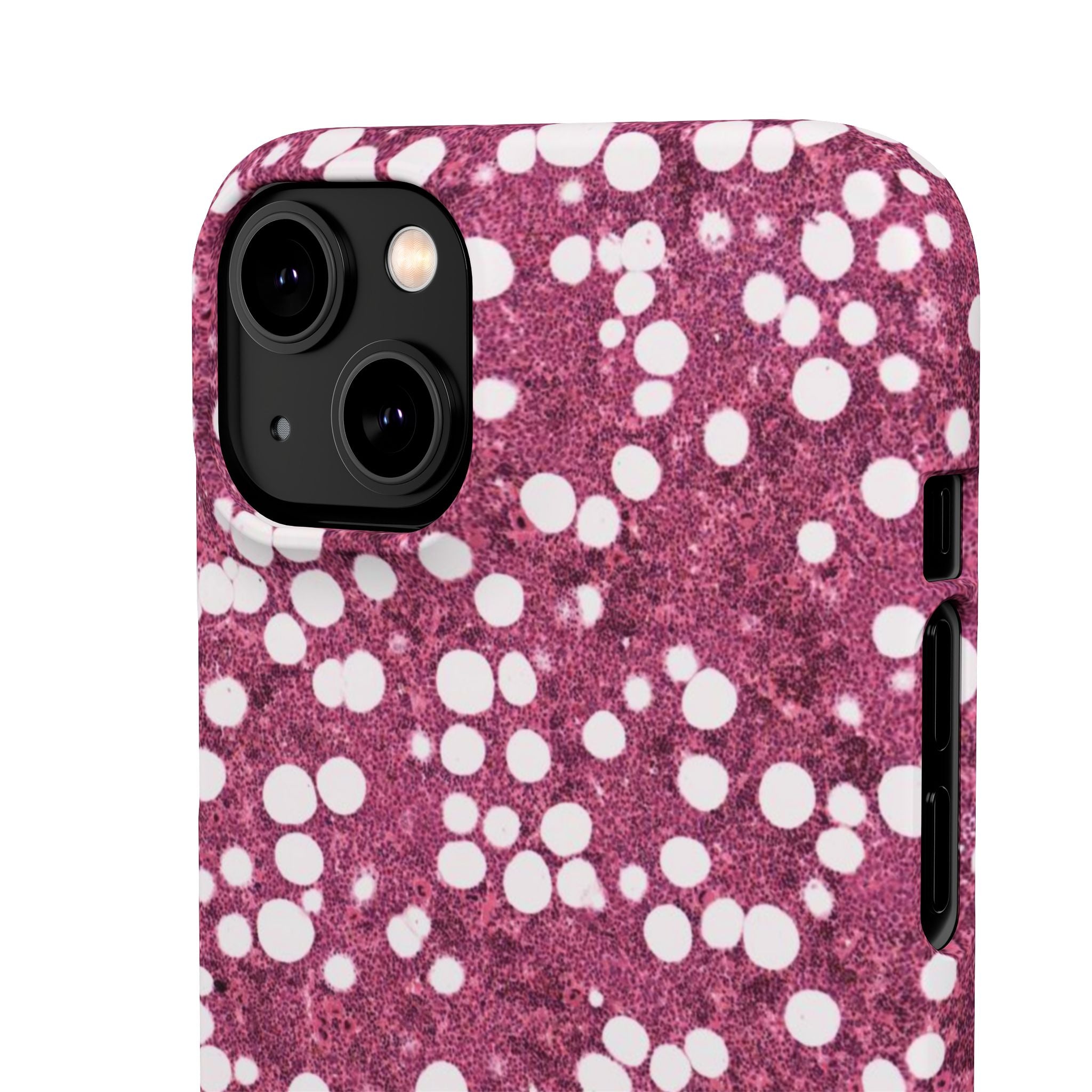 Slim Case Myelolipom