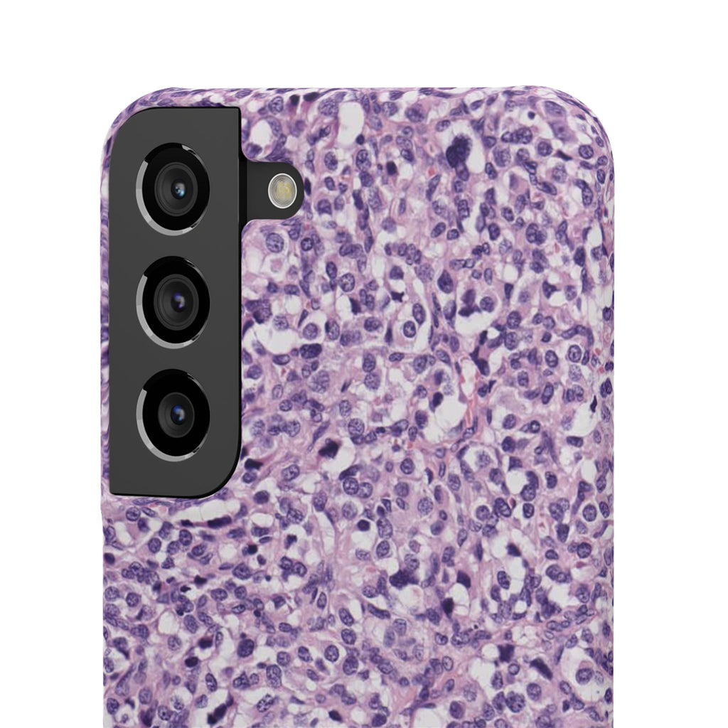 Slim Case Paraganglion
