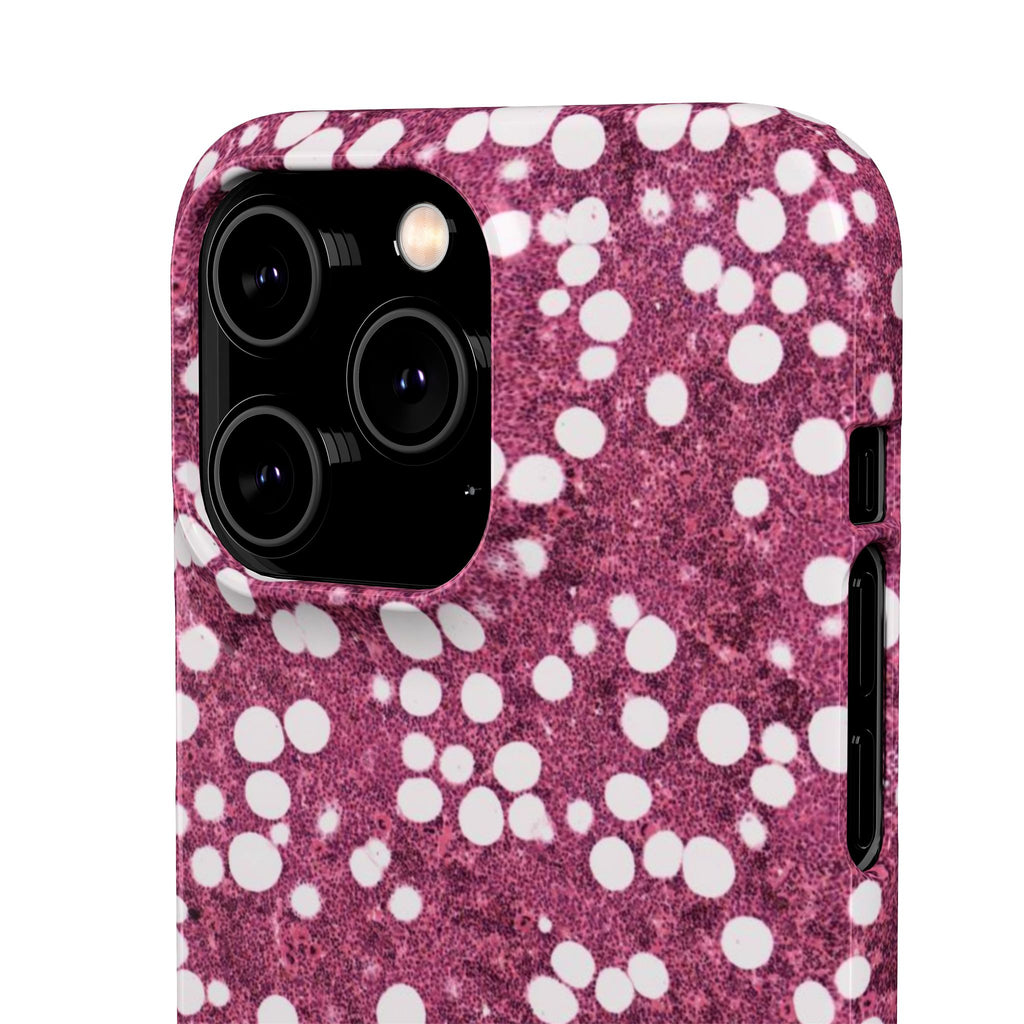 Slim Case Myelolipom