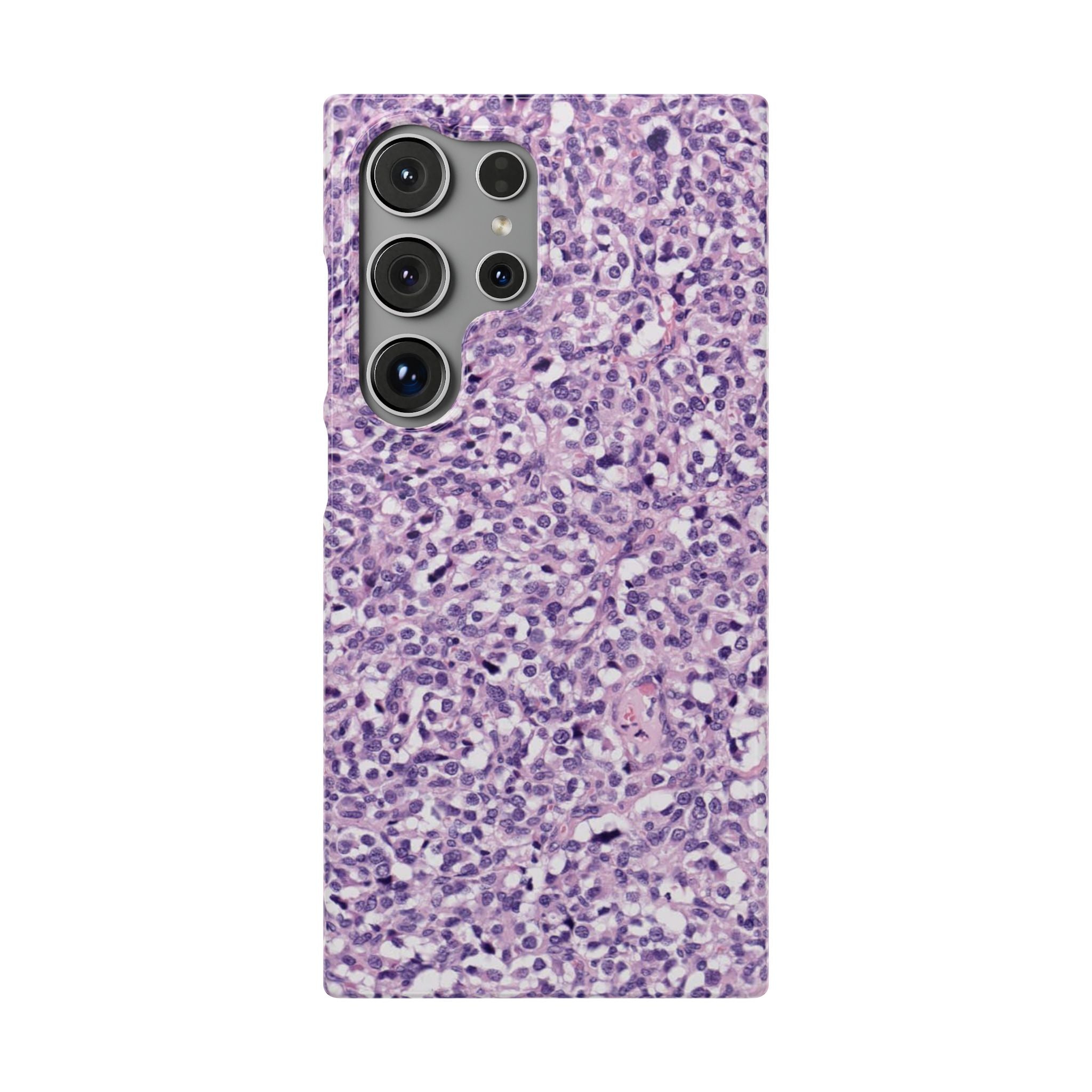 Slim Case Paraganglion