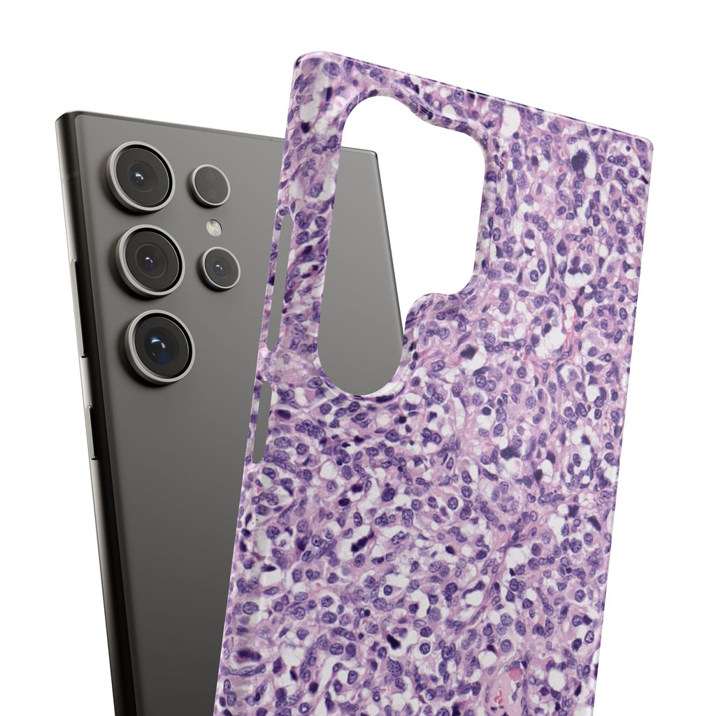 Slim Case Paraganglion
