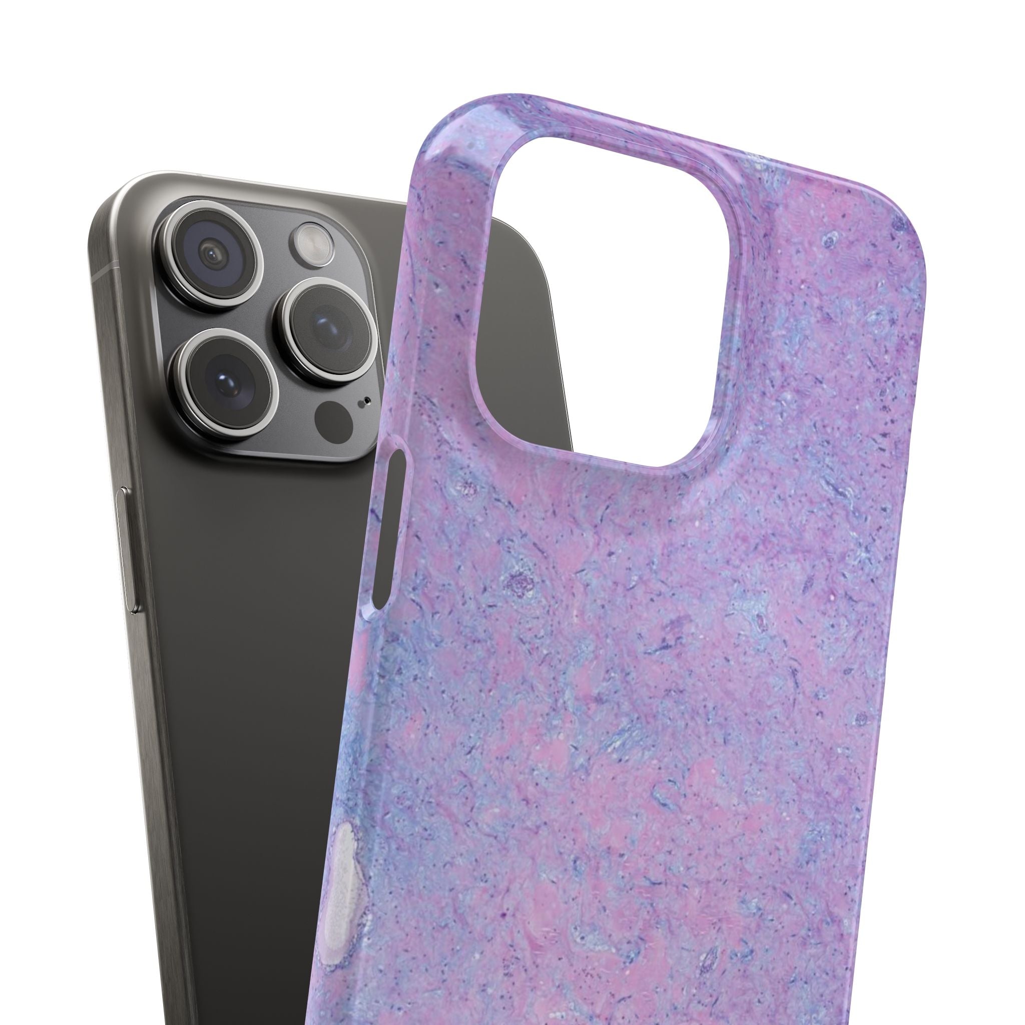 Slim Case Arterielles Myxom