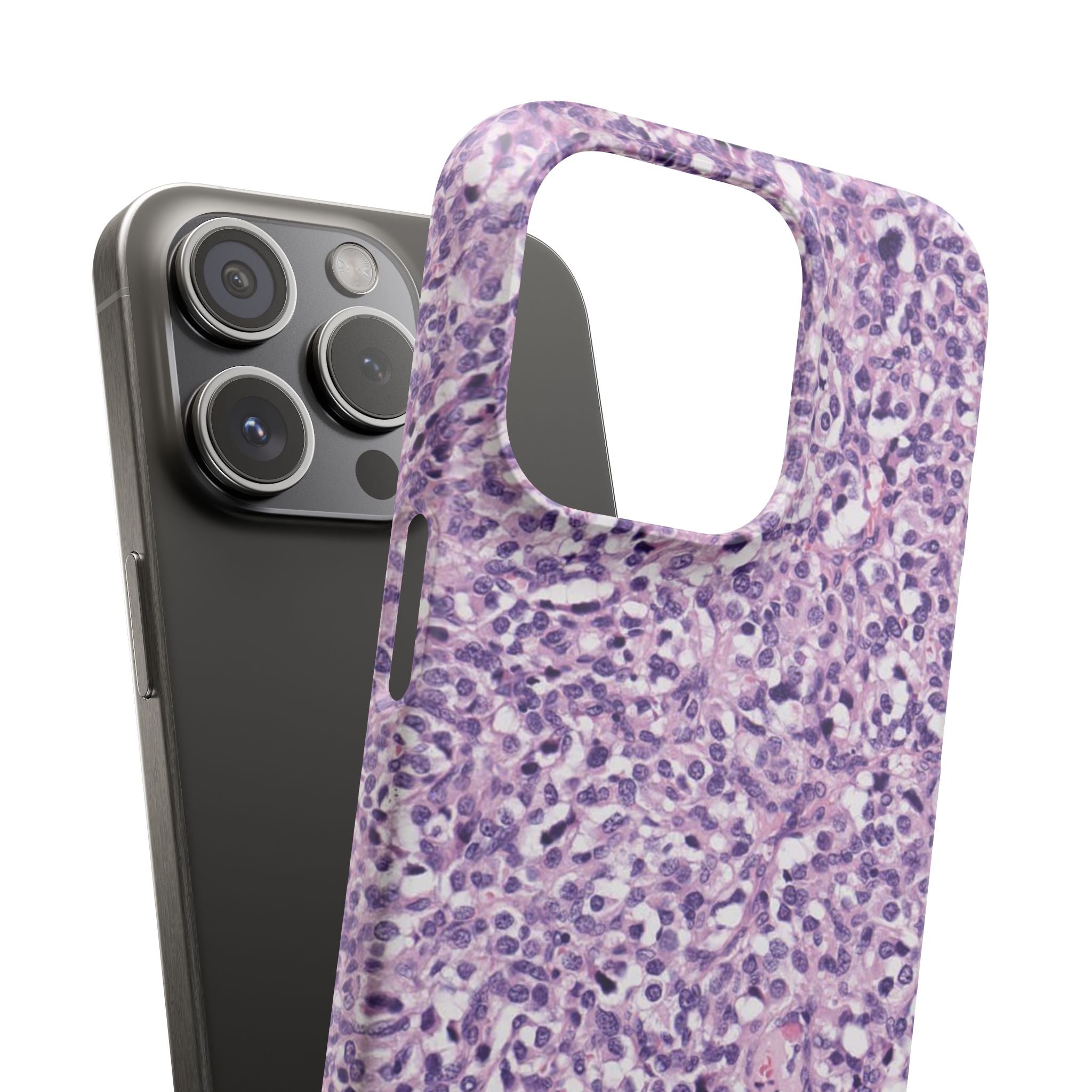 Slim Case Paraganglion