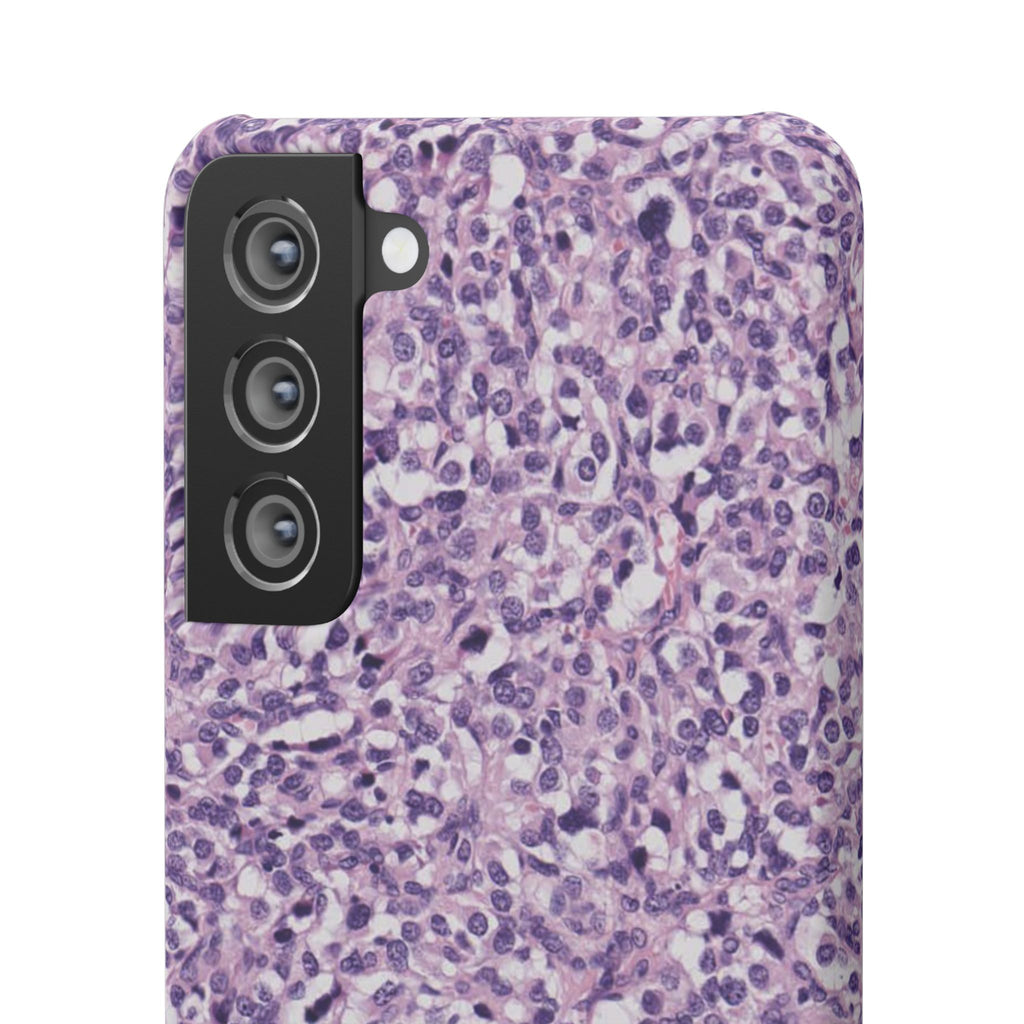 Slim Case Paraganglion