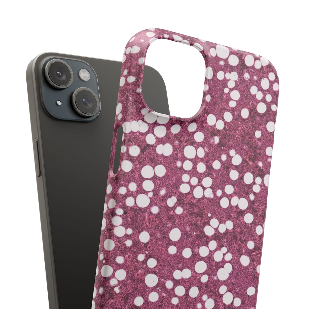 Slim Case Myelolipom