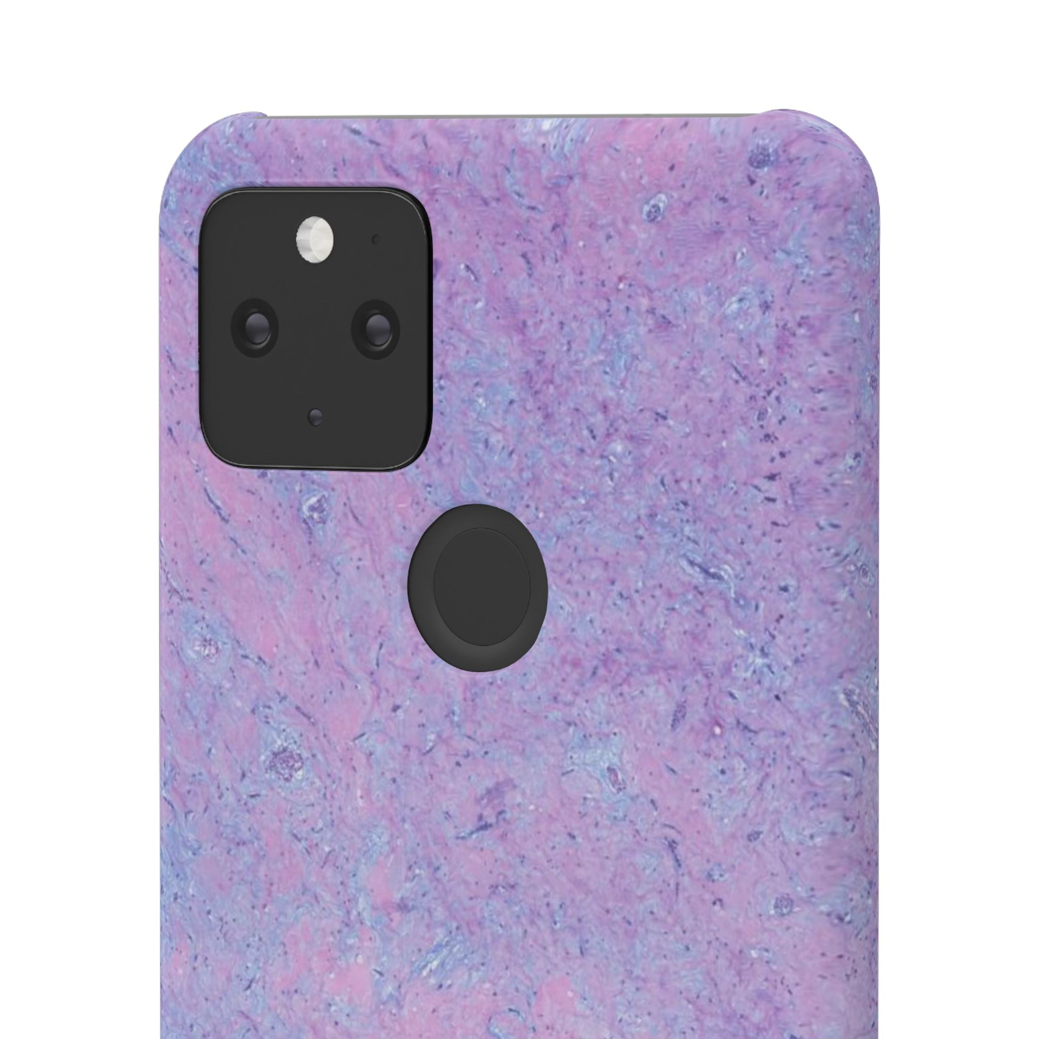 Slim Case Arterielles Myxom