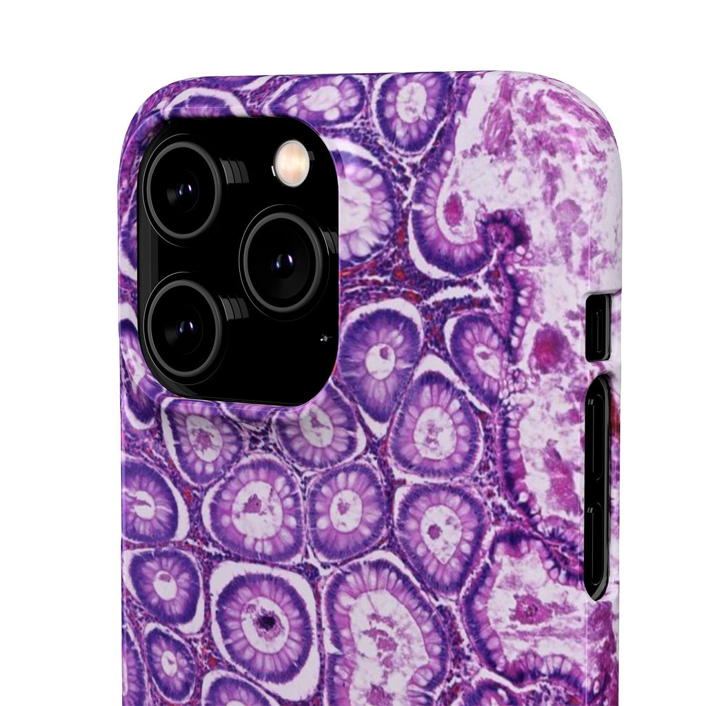 Slim Case Peutz-Jeghers Polyp