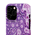 Slim Case Peutz-Jeghers Polyp