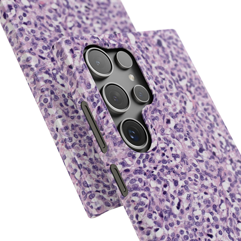 Slim Case Paraganglion
